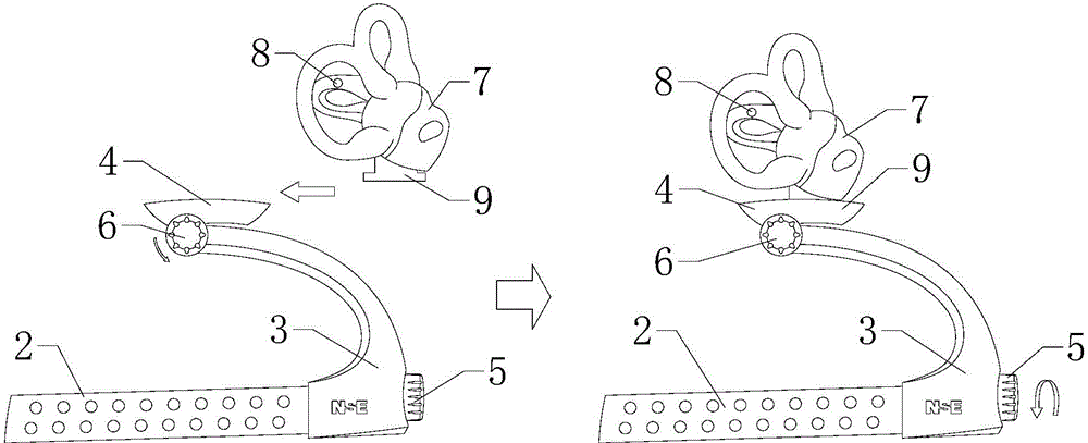 Otolithiasis treatment apparatus