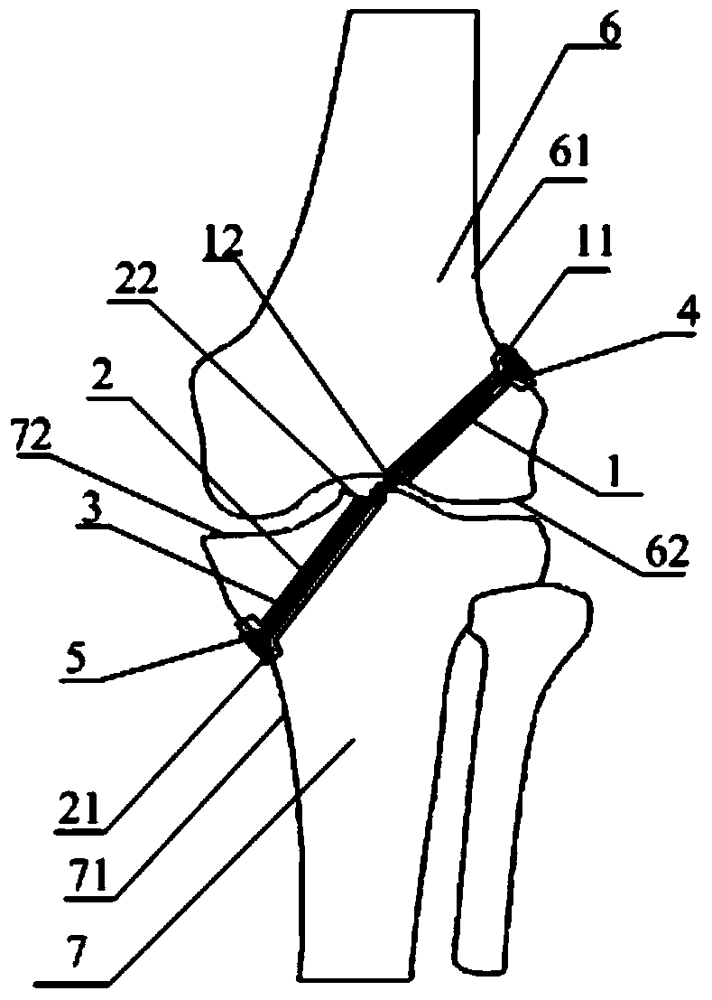 Ligament reestablishing system