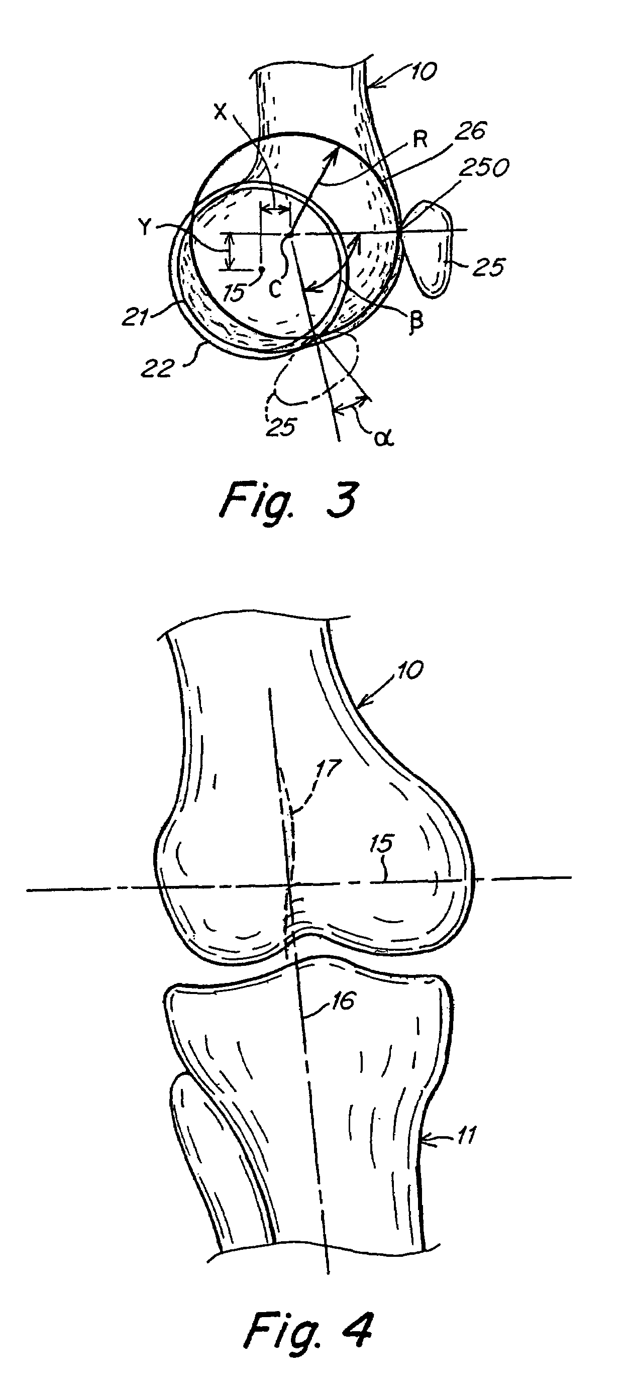 Knee joint prosthesis with a femoral component which links the tibiofemoral axis of rotation with the patellofemoral axis of rotation