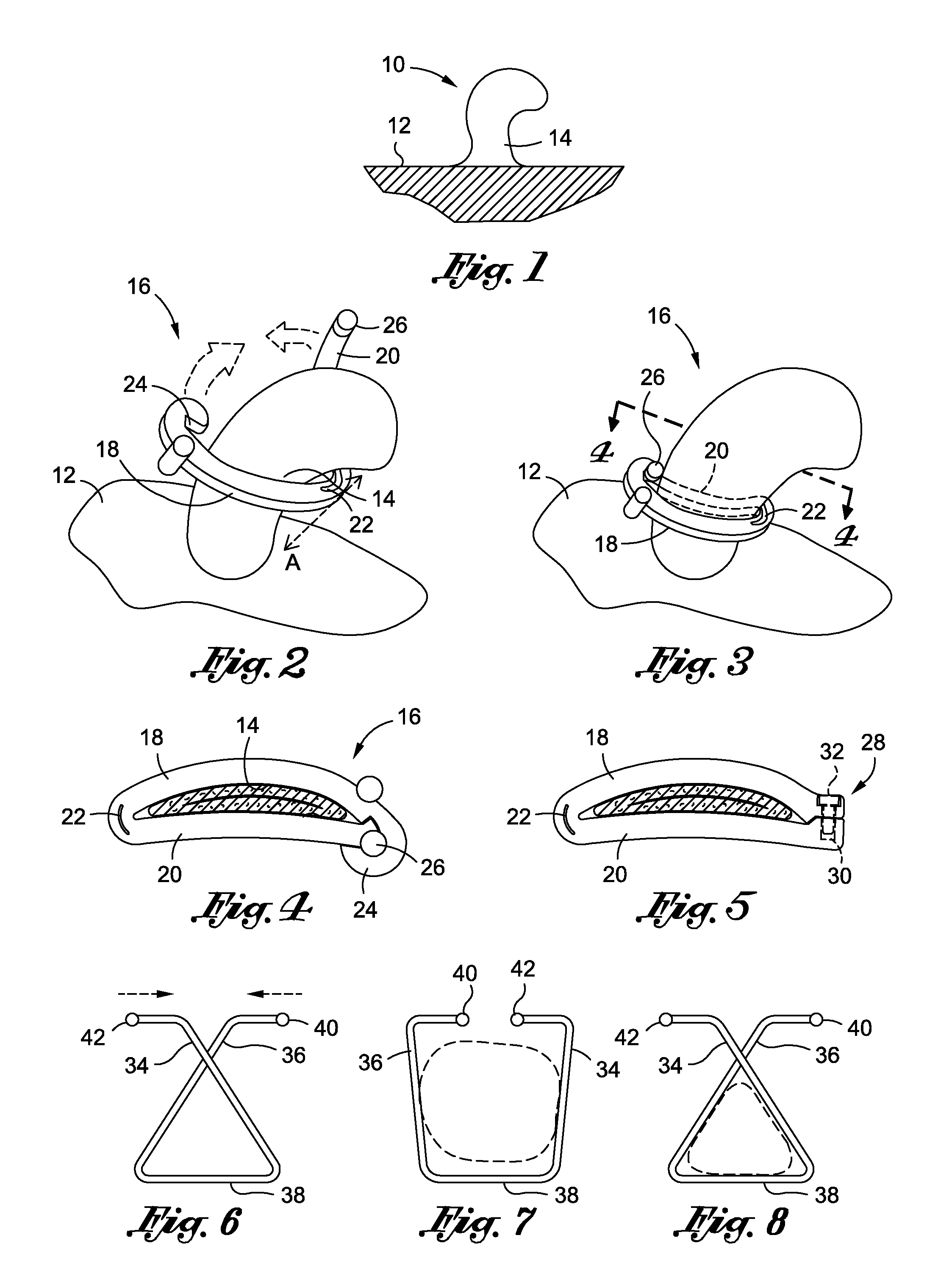 Skin tag removal system