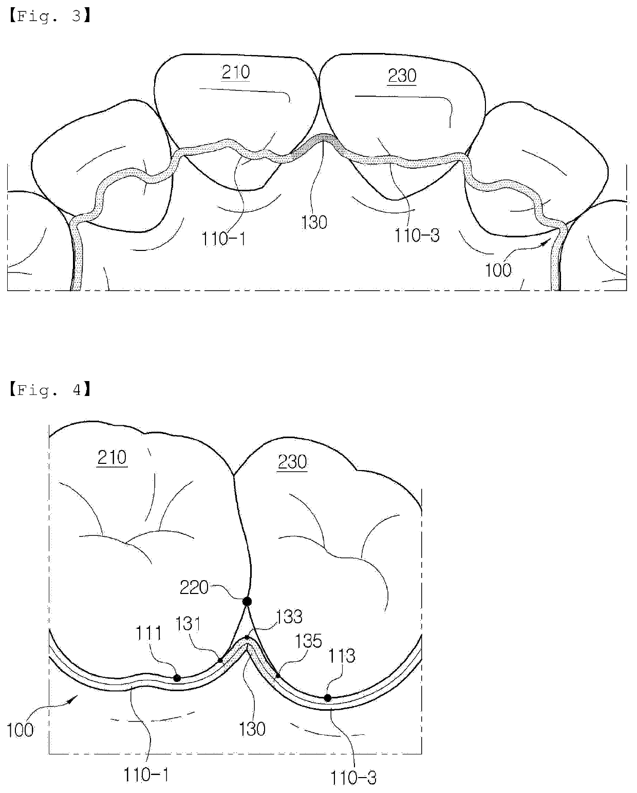 Retainer for maintaining teeth alignment of wearer