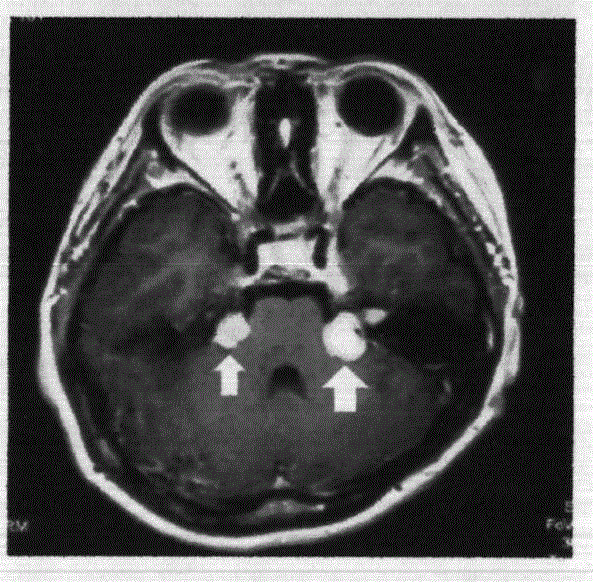 Kit for external detection of Neurofibromastosis 2 disease causative gene NF2 c.1598delA mutation