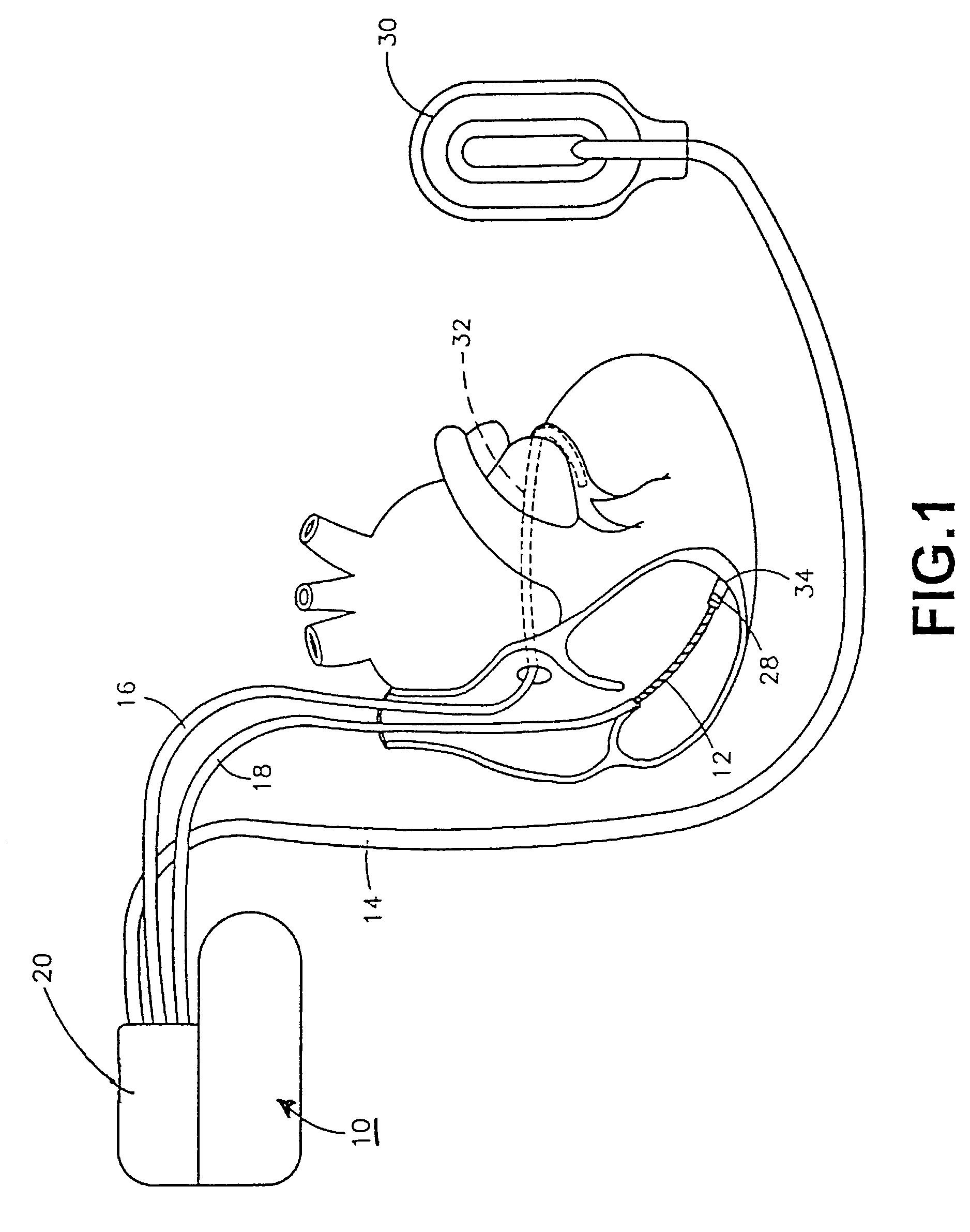 Implantable medical device having flat electrolytic capacitor with porous gas vent within electrolyte fill tube