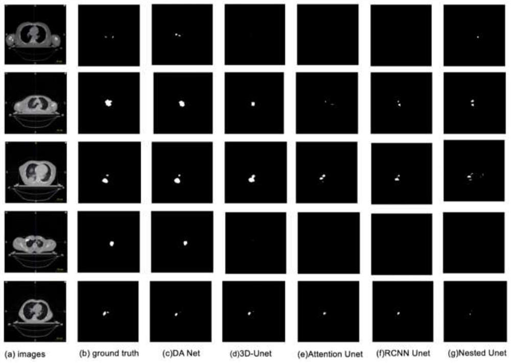 Medical image small lesion segmentation method