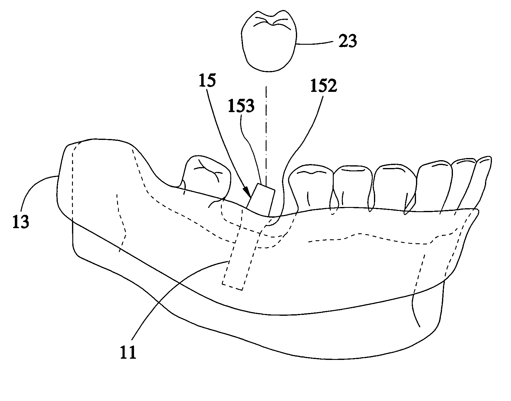 Method for designing a digital abutment for dental implant