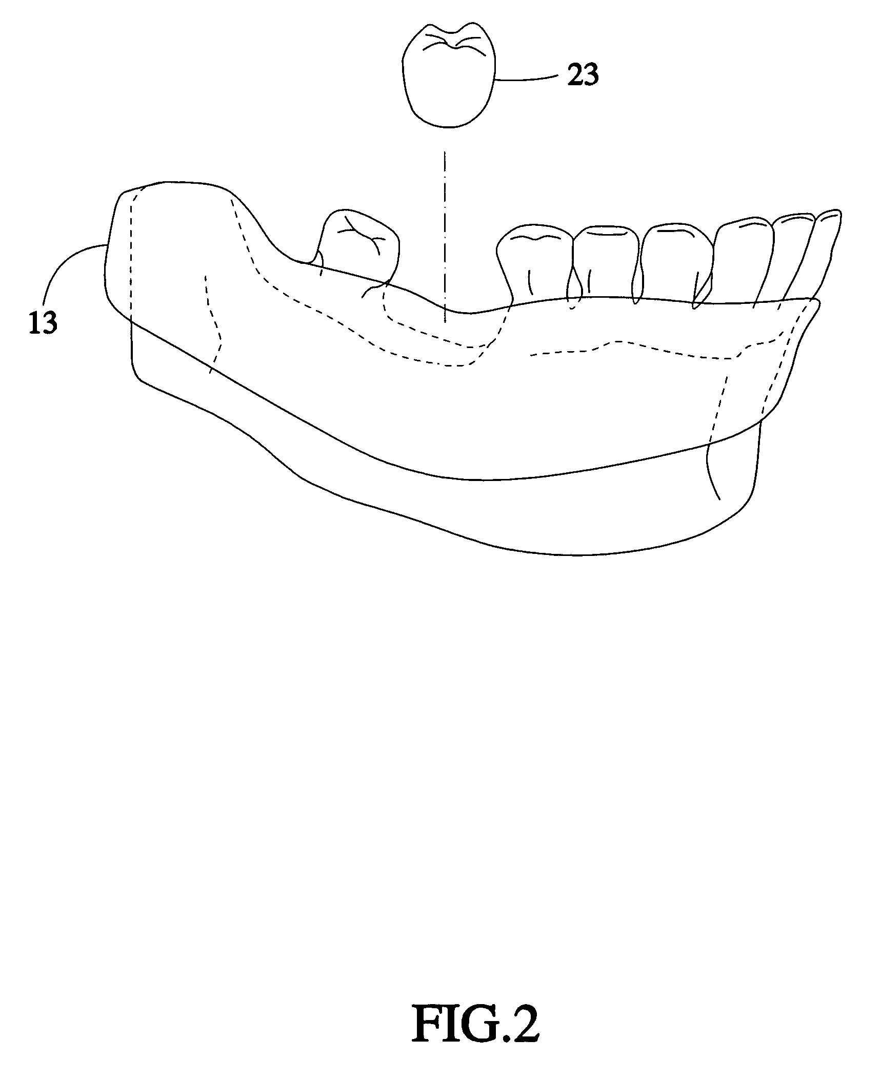 Method for designing a digital abutment for dental implant