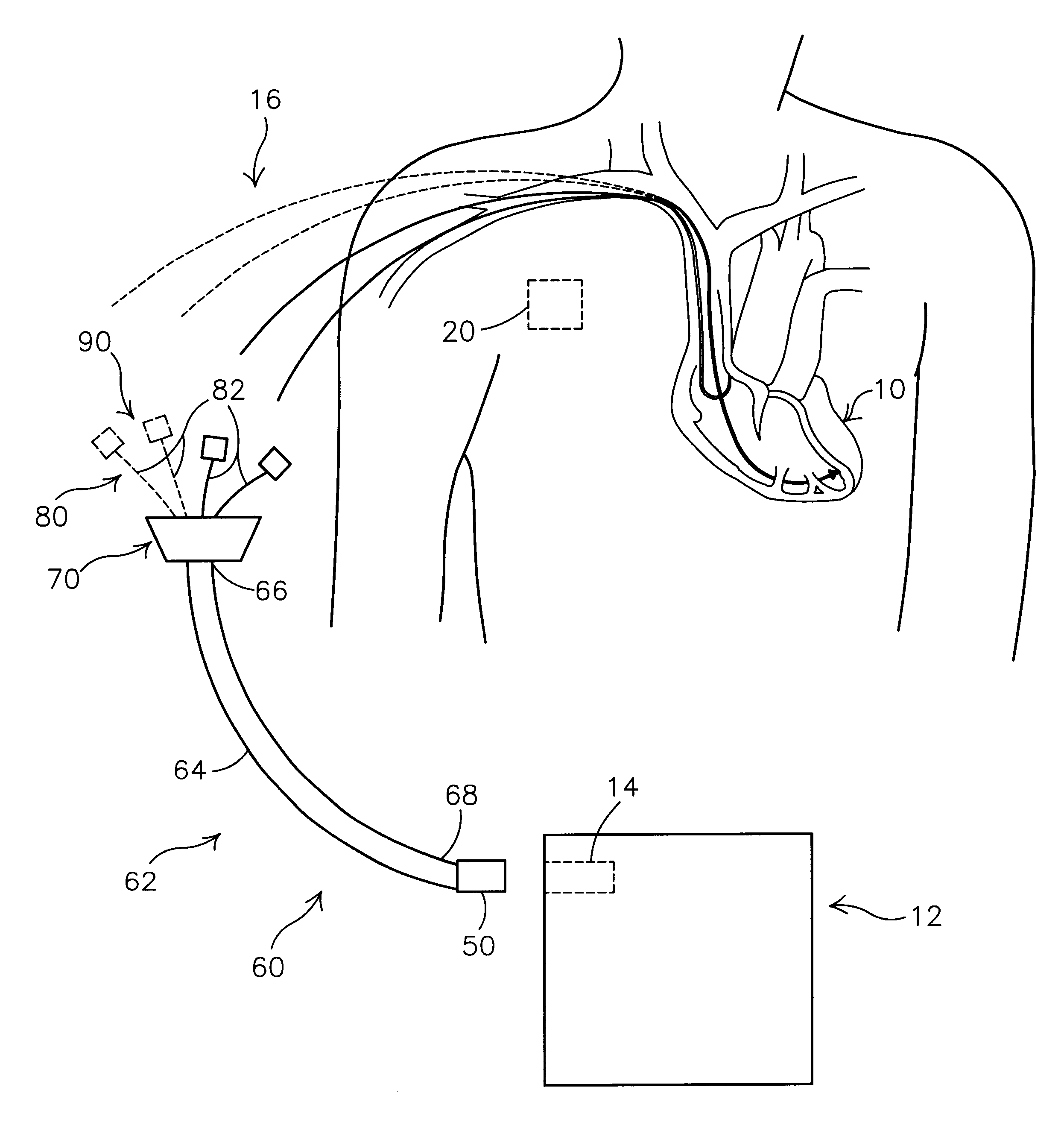 Bi-atrial and/or bi-ventricular patient safety cable and methods regarding same