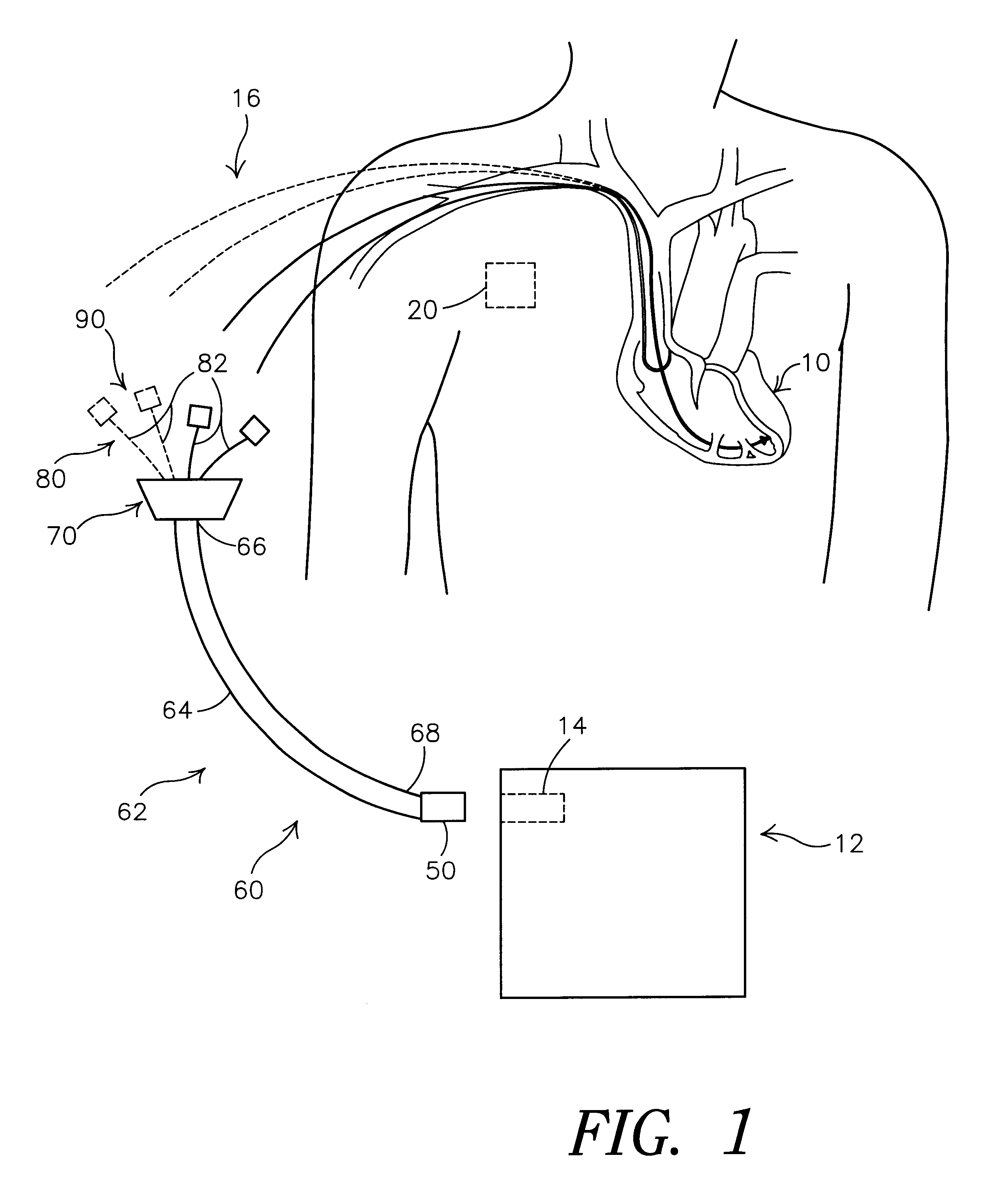 Bi-atrial and/or bi-ventricular patient safety cable and methods regarding same