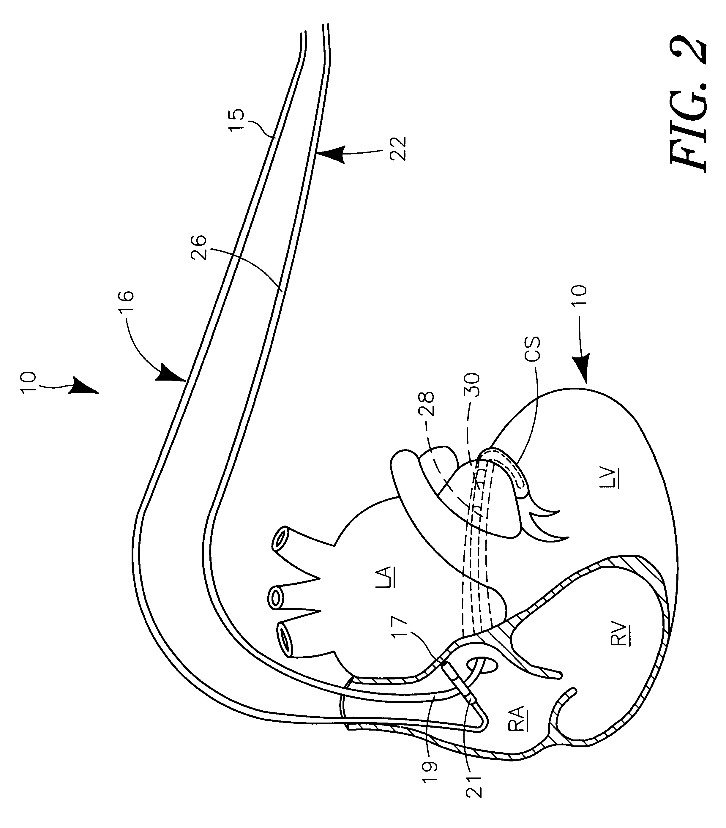 Bi-atrial and/or bi-ventricular patient safety cable and methods regarding same