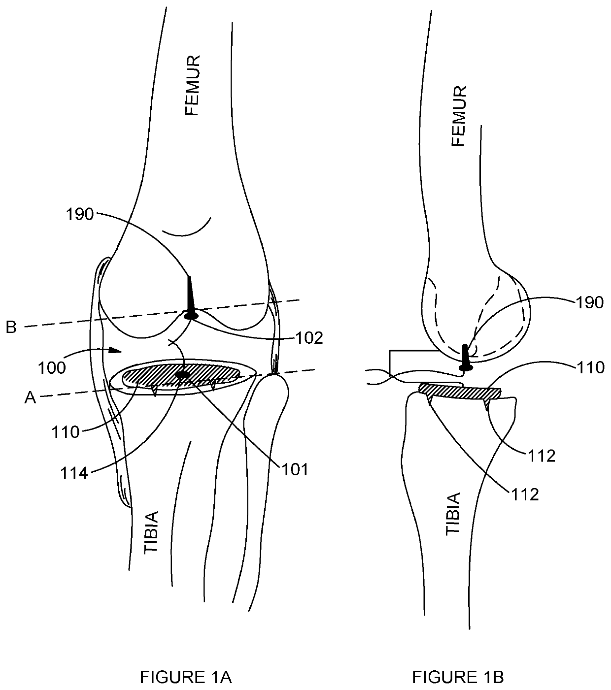 Soft Tissue Tension and Bone Resection Instruments and methods