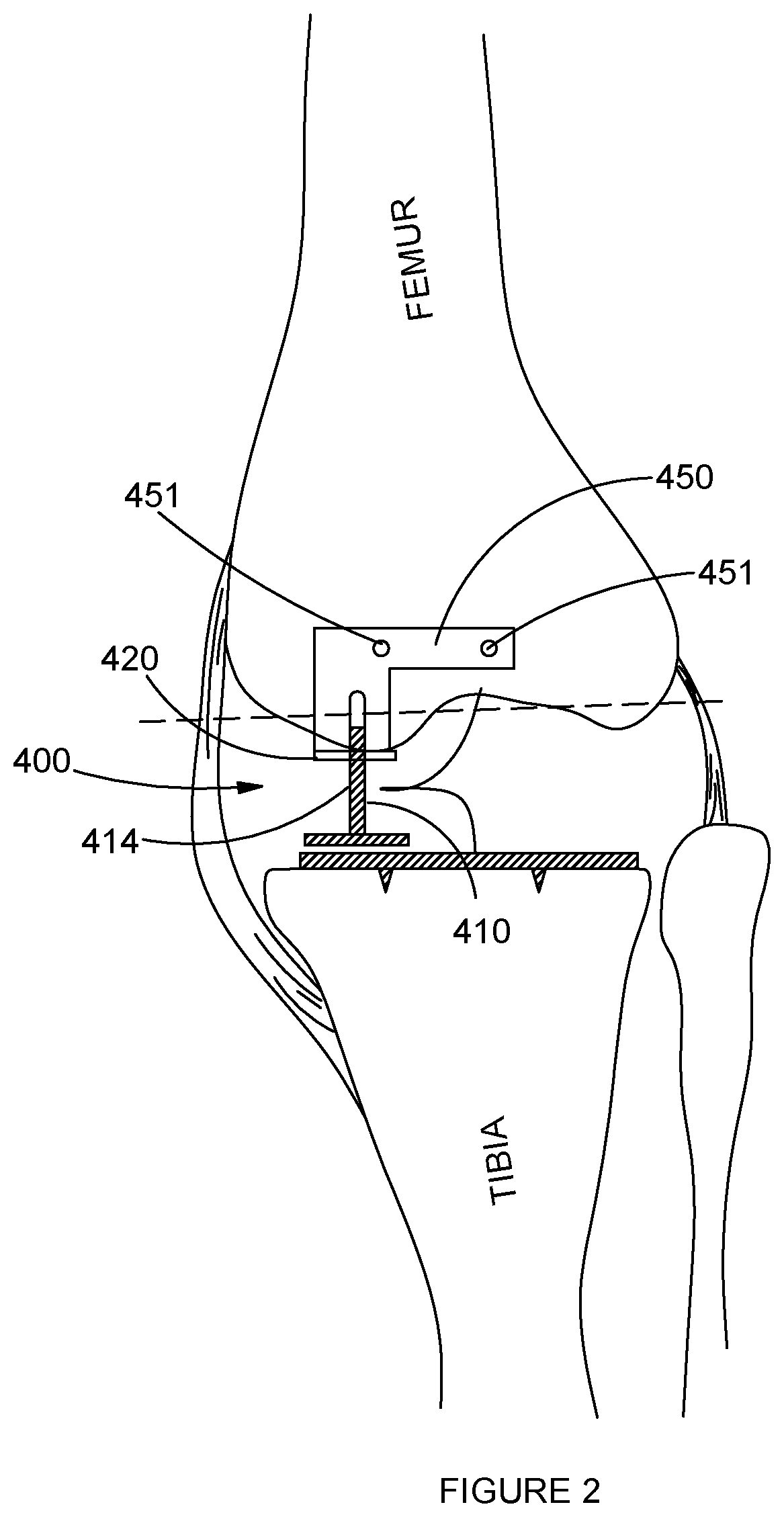 Soft Tissue Tension and Bone Resection Instruments and methods