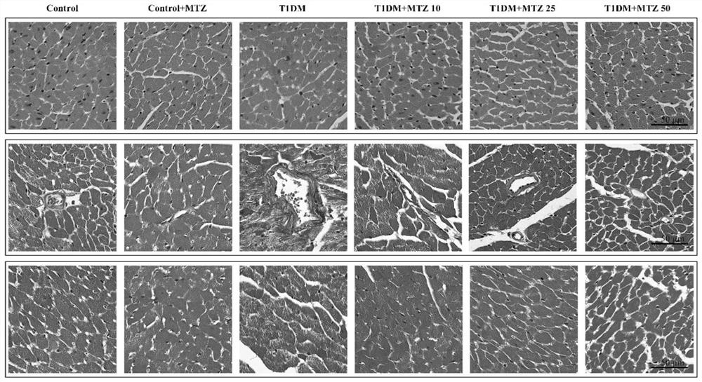 Application of methazolamide in preparation of medicine for treating type 1 diabetic cardiomyopathy