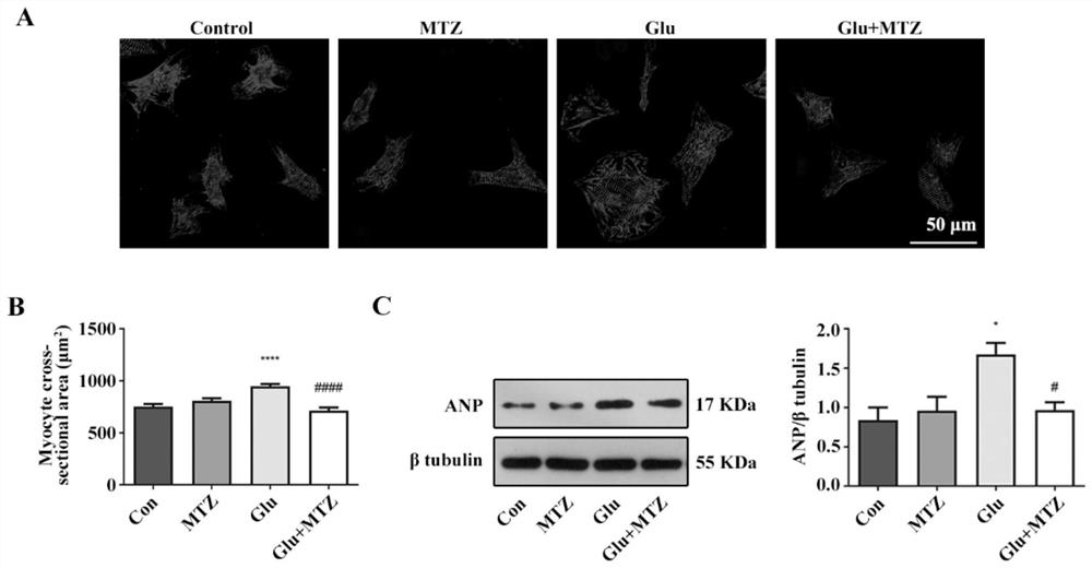 Application of methazolamide in preparation of medicine for treating type 1 diabetic cardiomyopathy