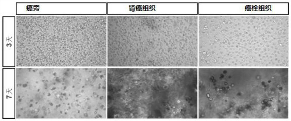 Organ-like combination related to kidney cancer and application thereof