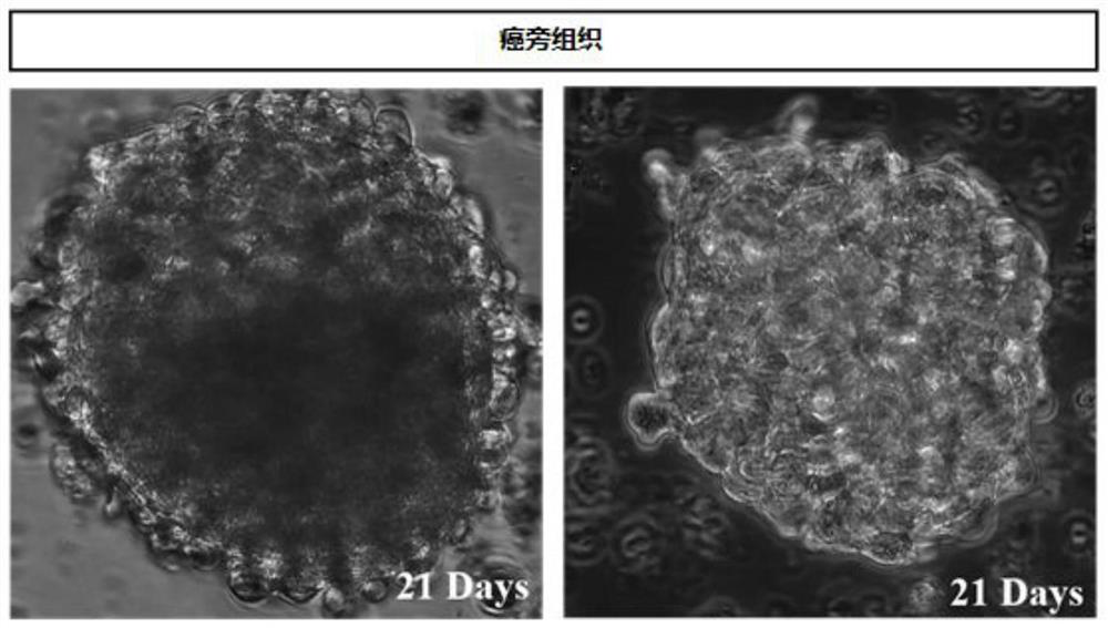 Organ-like combination related to kidney cancer and application thereof