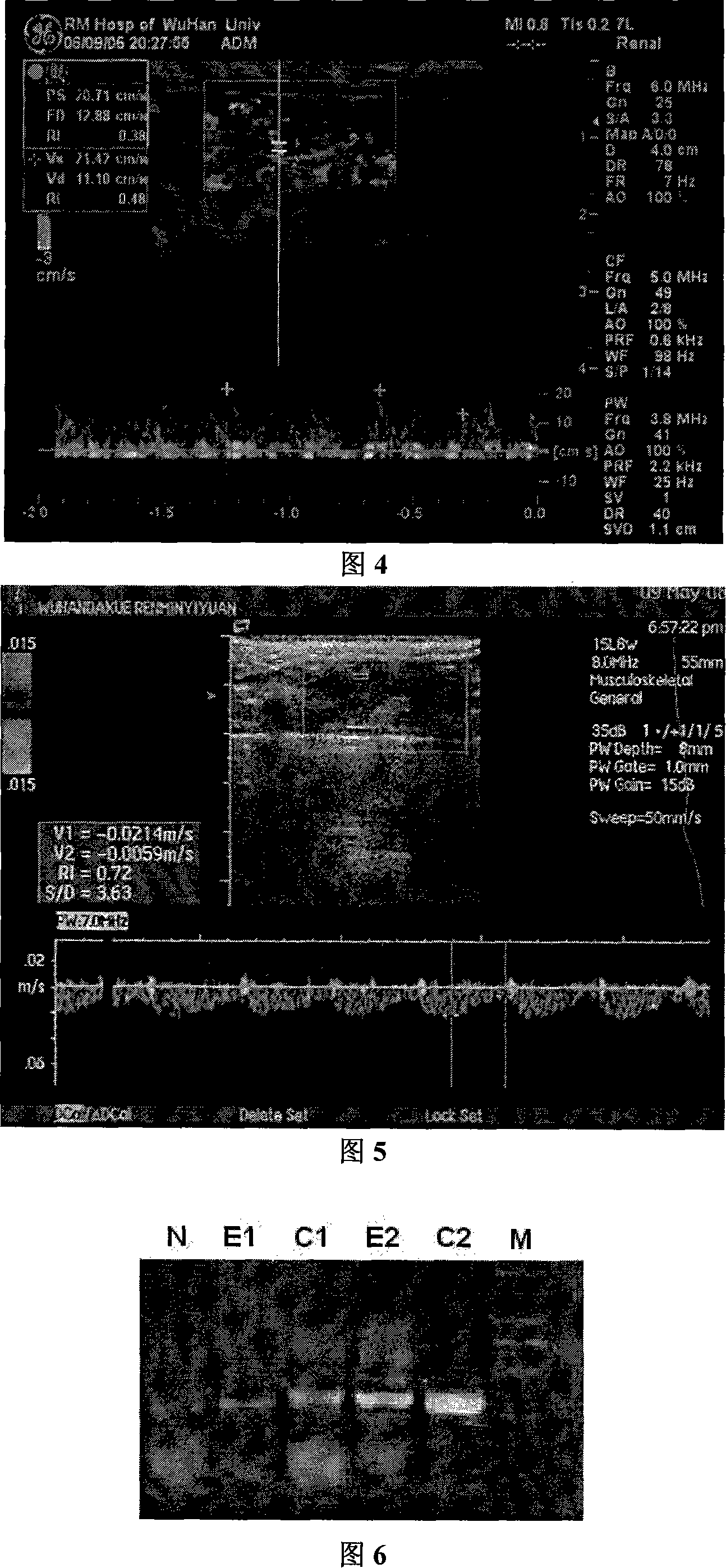 Application of Lefty protein in restraining fibrosis lesion of organ