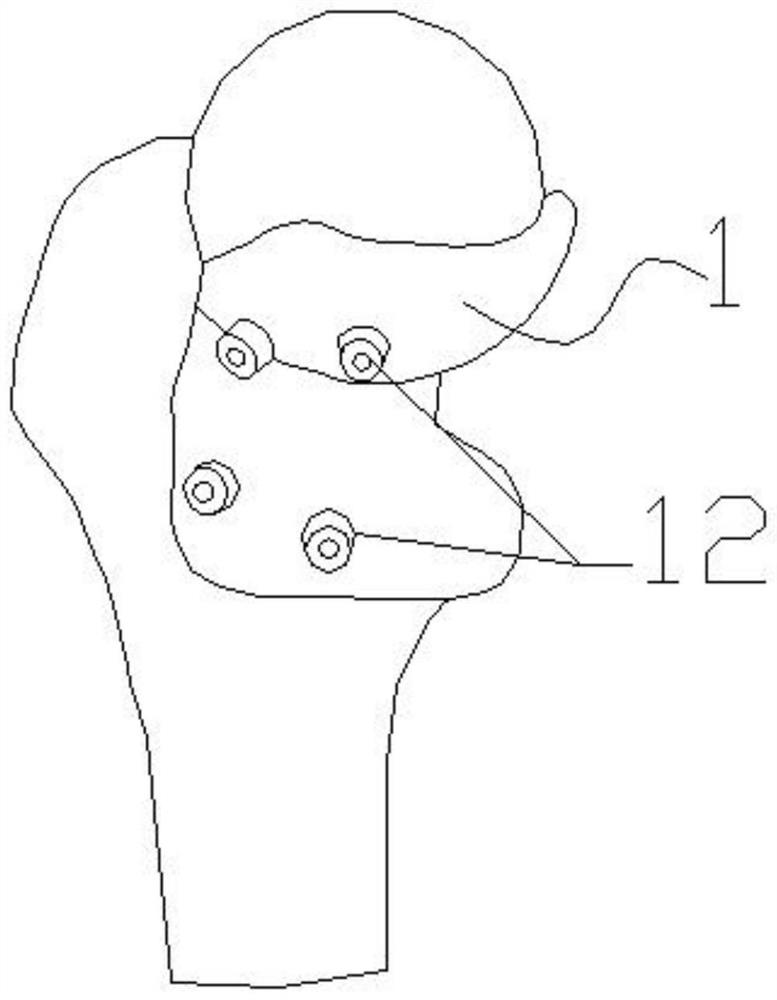 Apparatus and method for restoration and verification of femoral angle