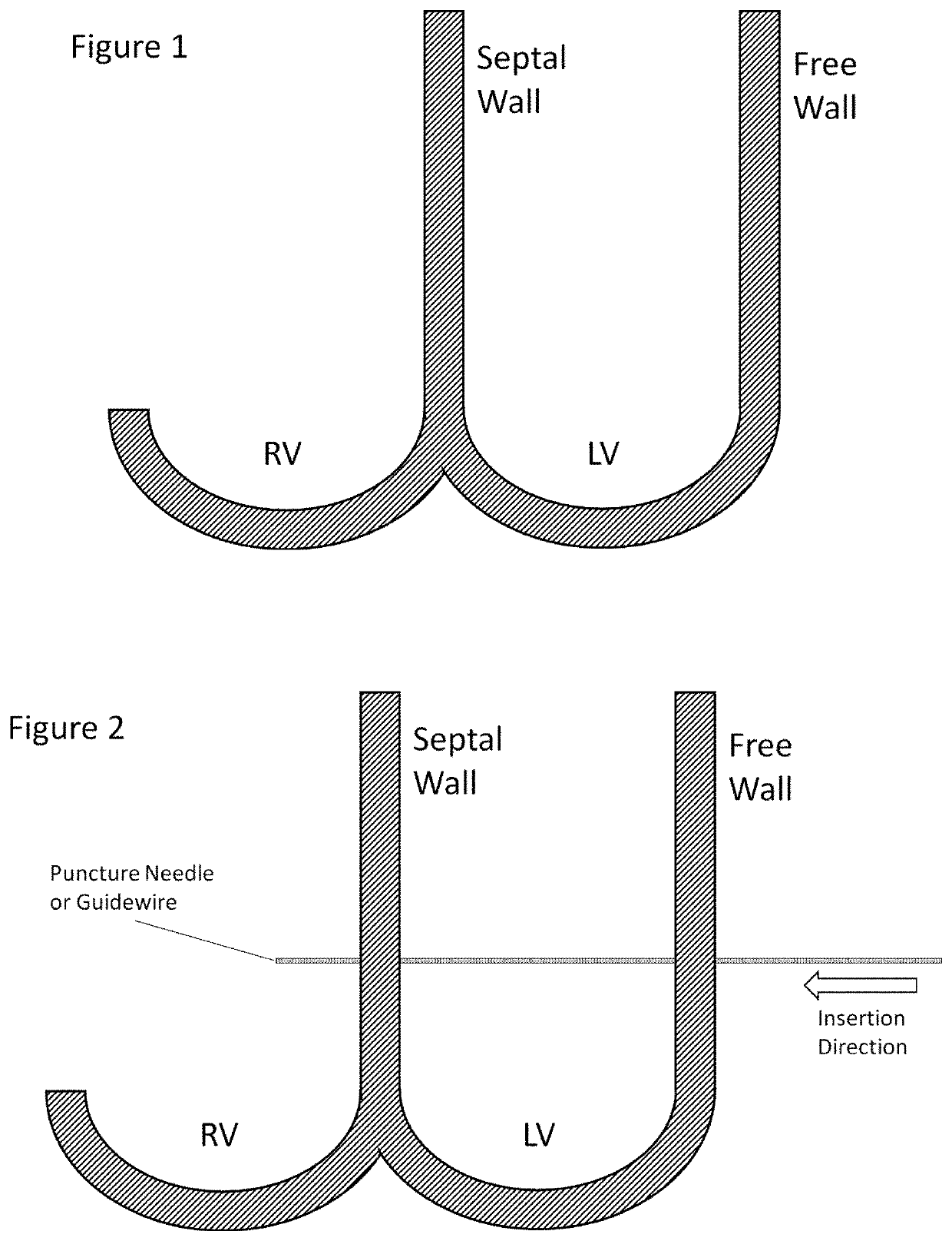 Mechanically locking adjustable cardiac tether