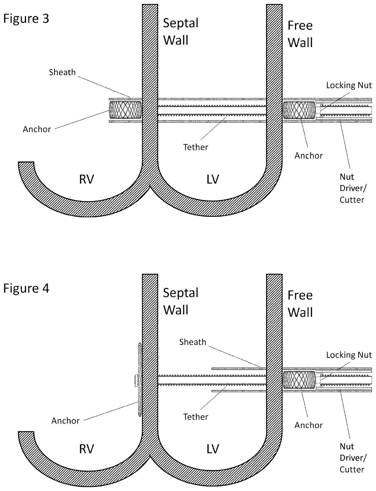 Mechanically locking adjustable cardiac tether