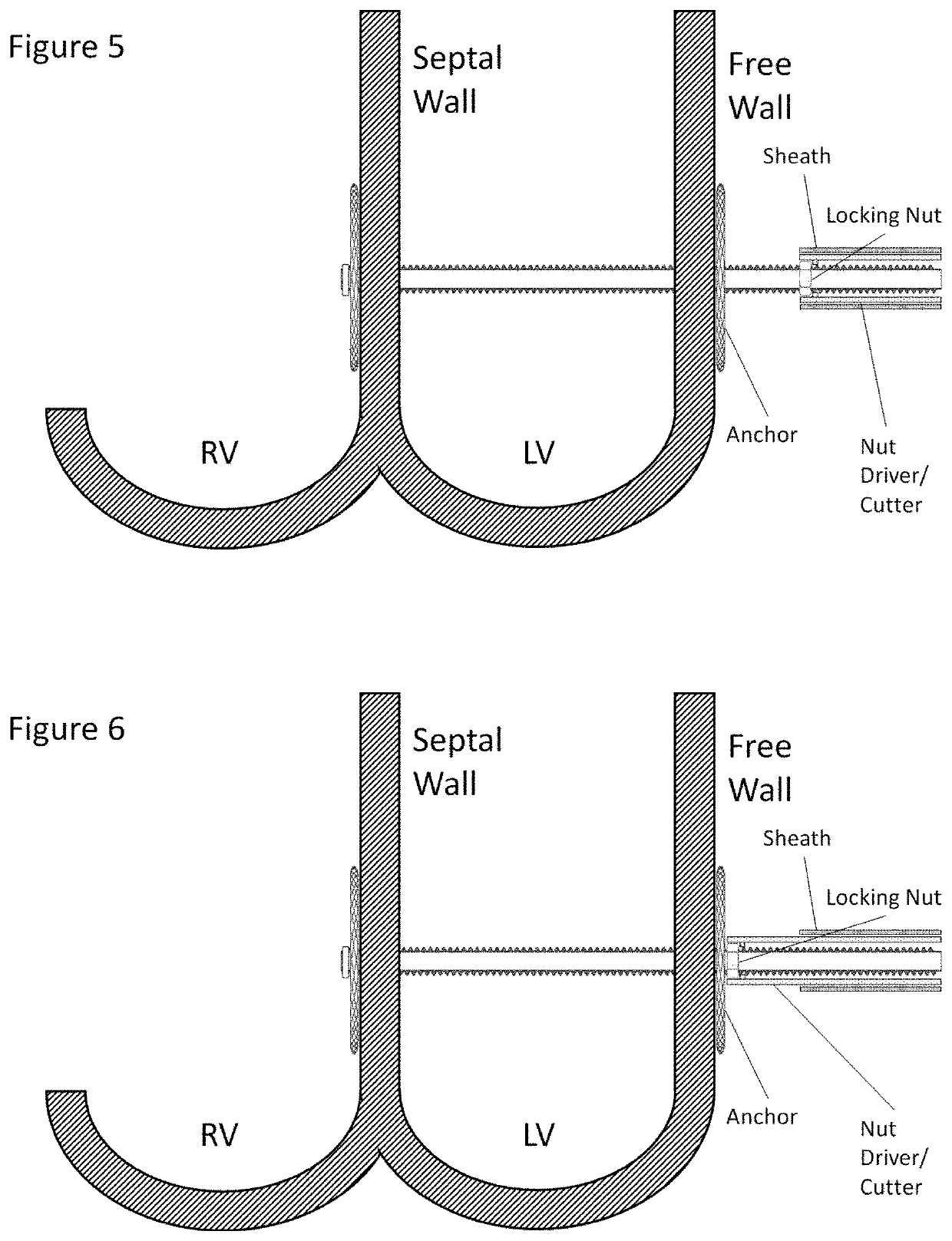 Mechanically locking adjustable cardiac tether