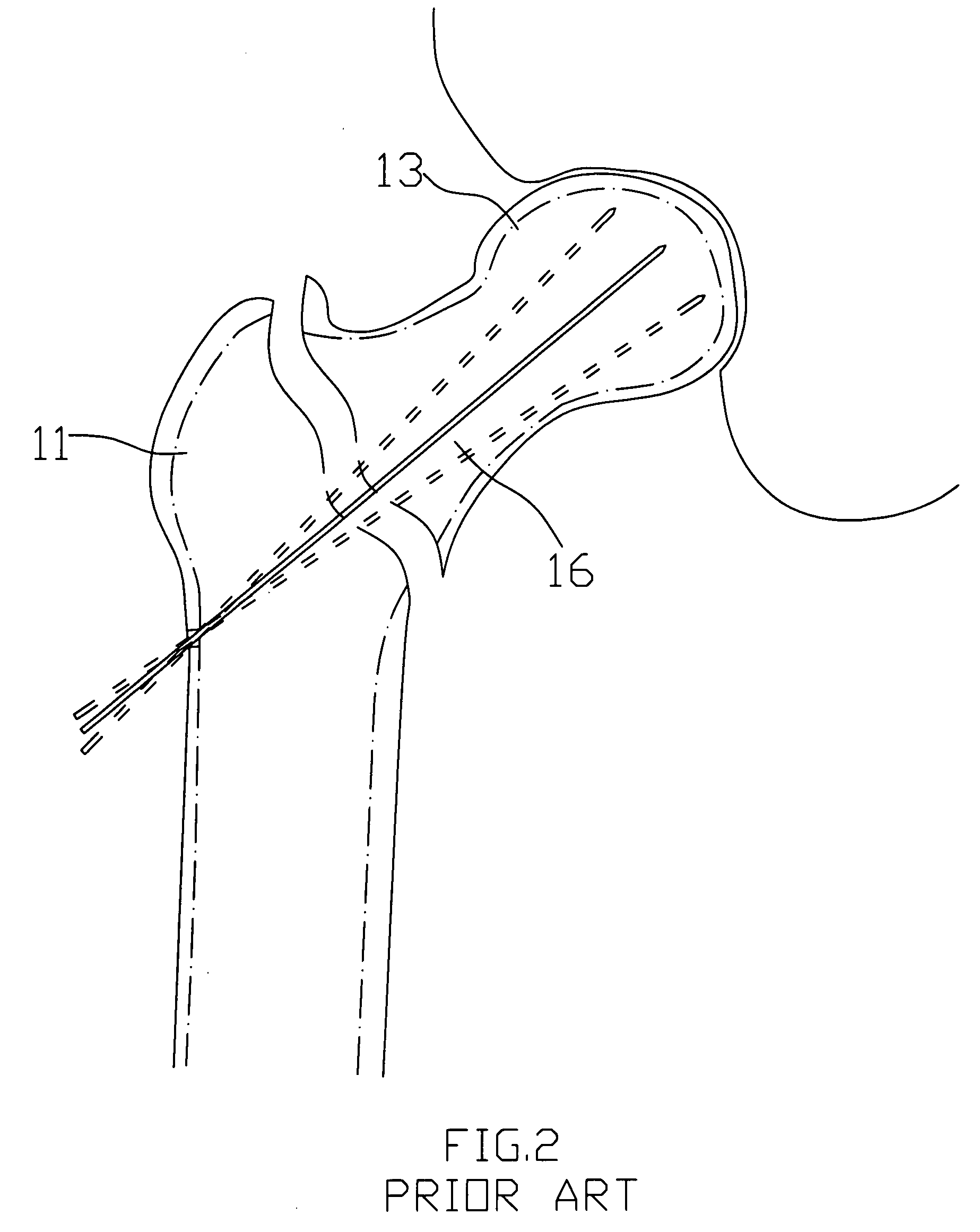 Targeting device for femur intertrochanteric fracture