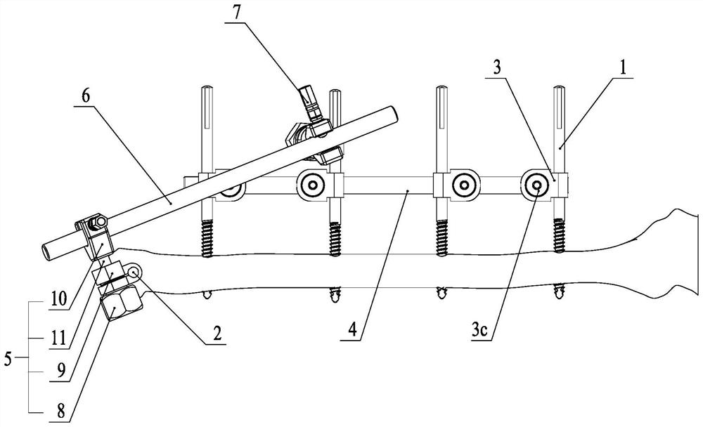 External fixation system with looseness monitoring function for tibia fracture reduction