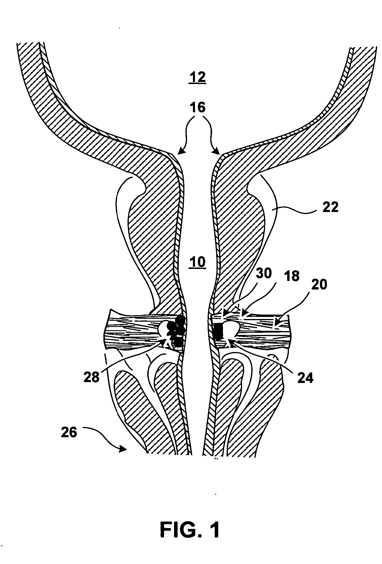 Implantable devices and methods for treating urinary incontinence