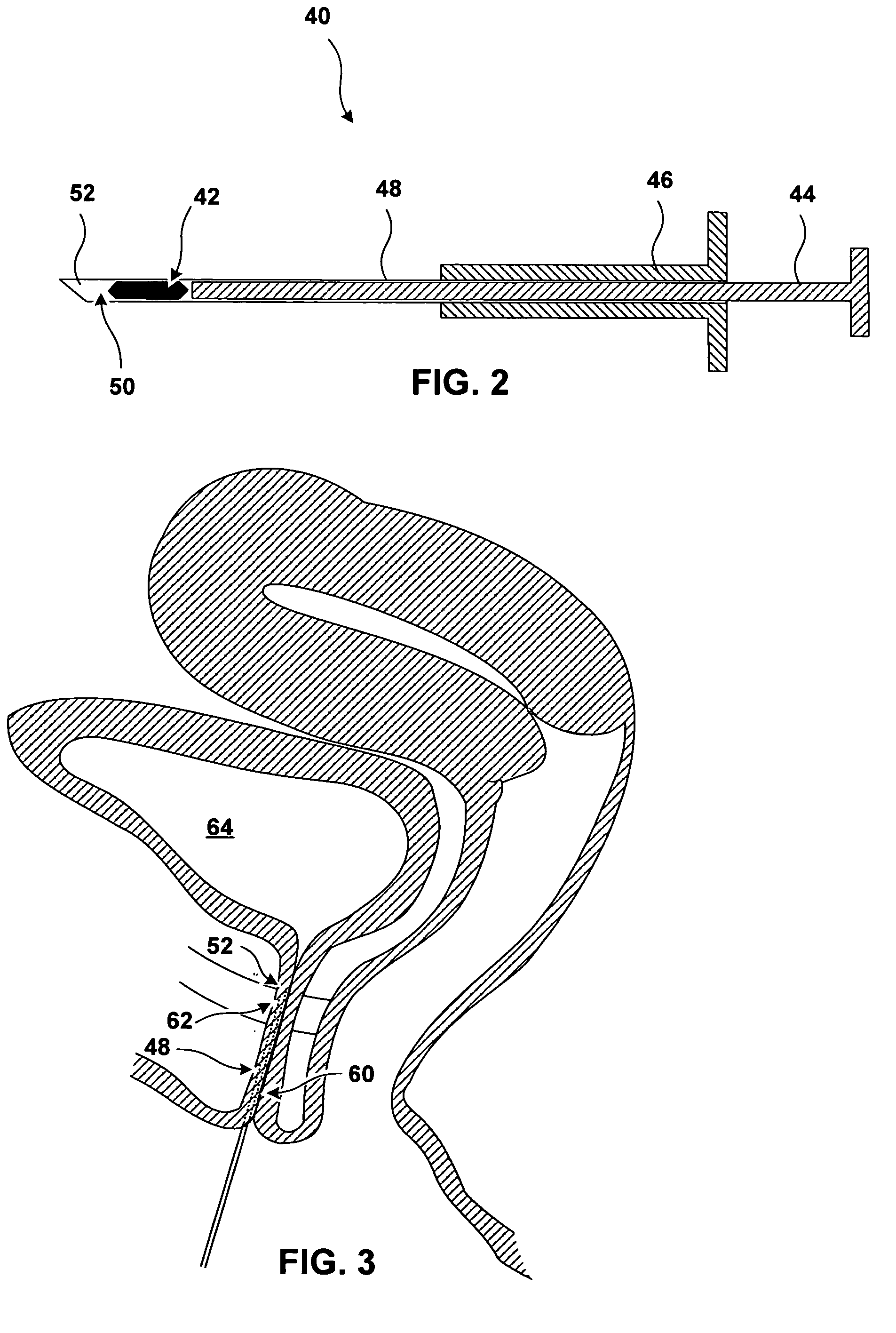 Implantable devices and methods for treating urinary incontinence