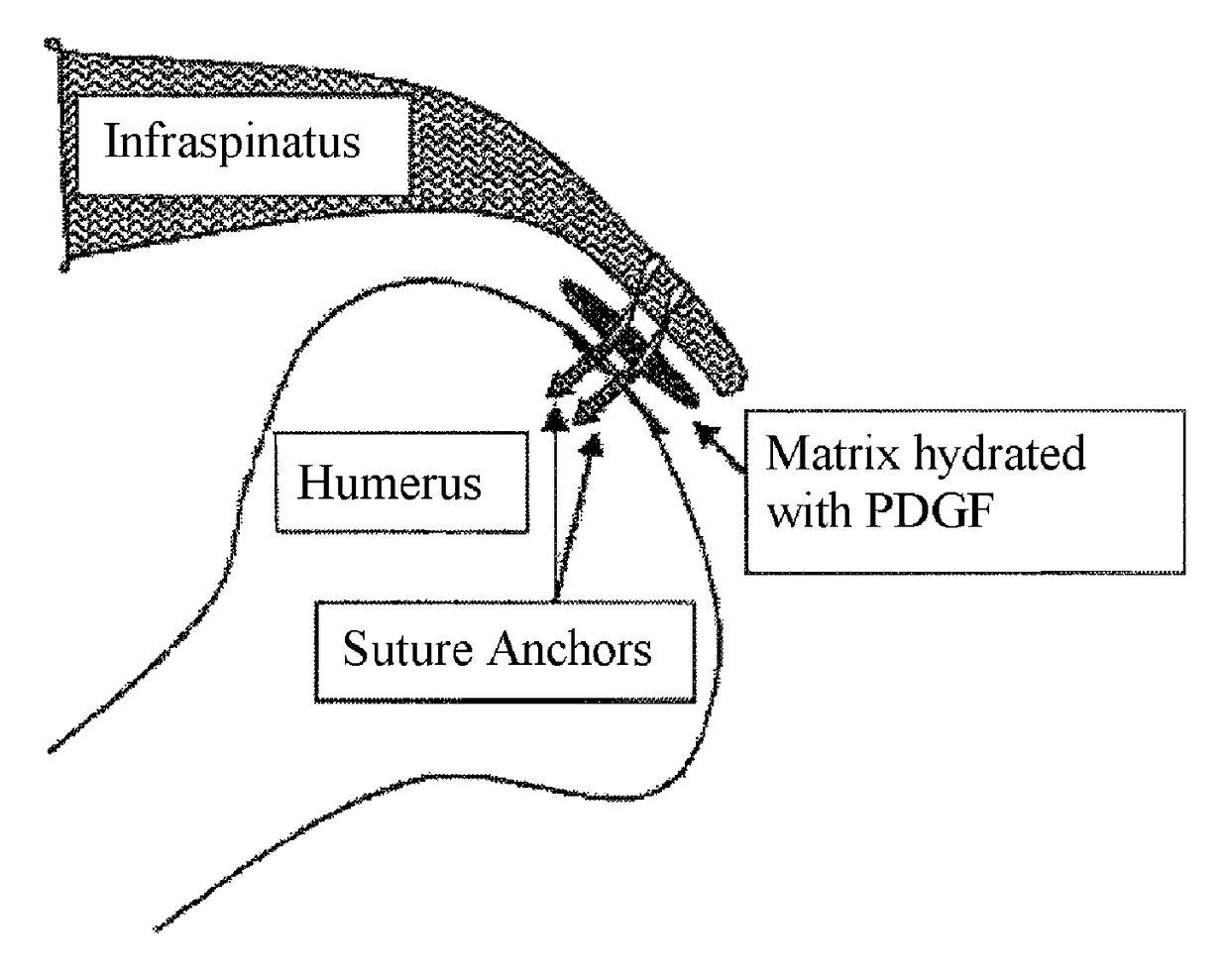 Compositions and methods for treating rotator cuff injuries