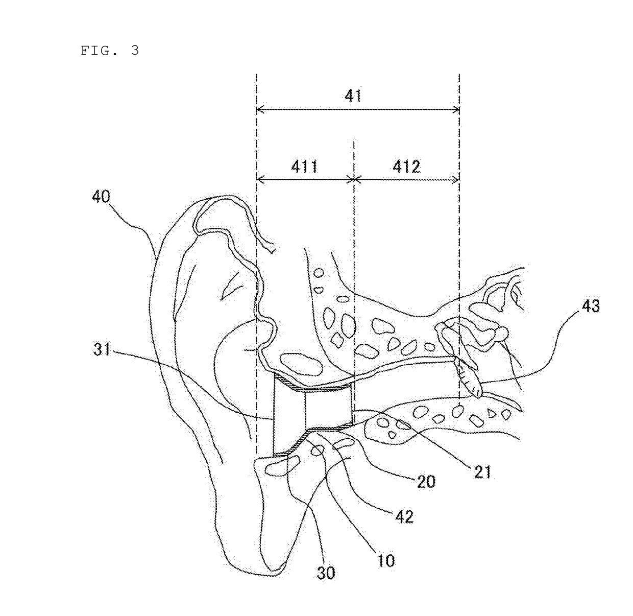 Simplified hearing aid