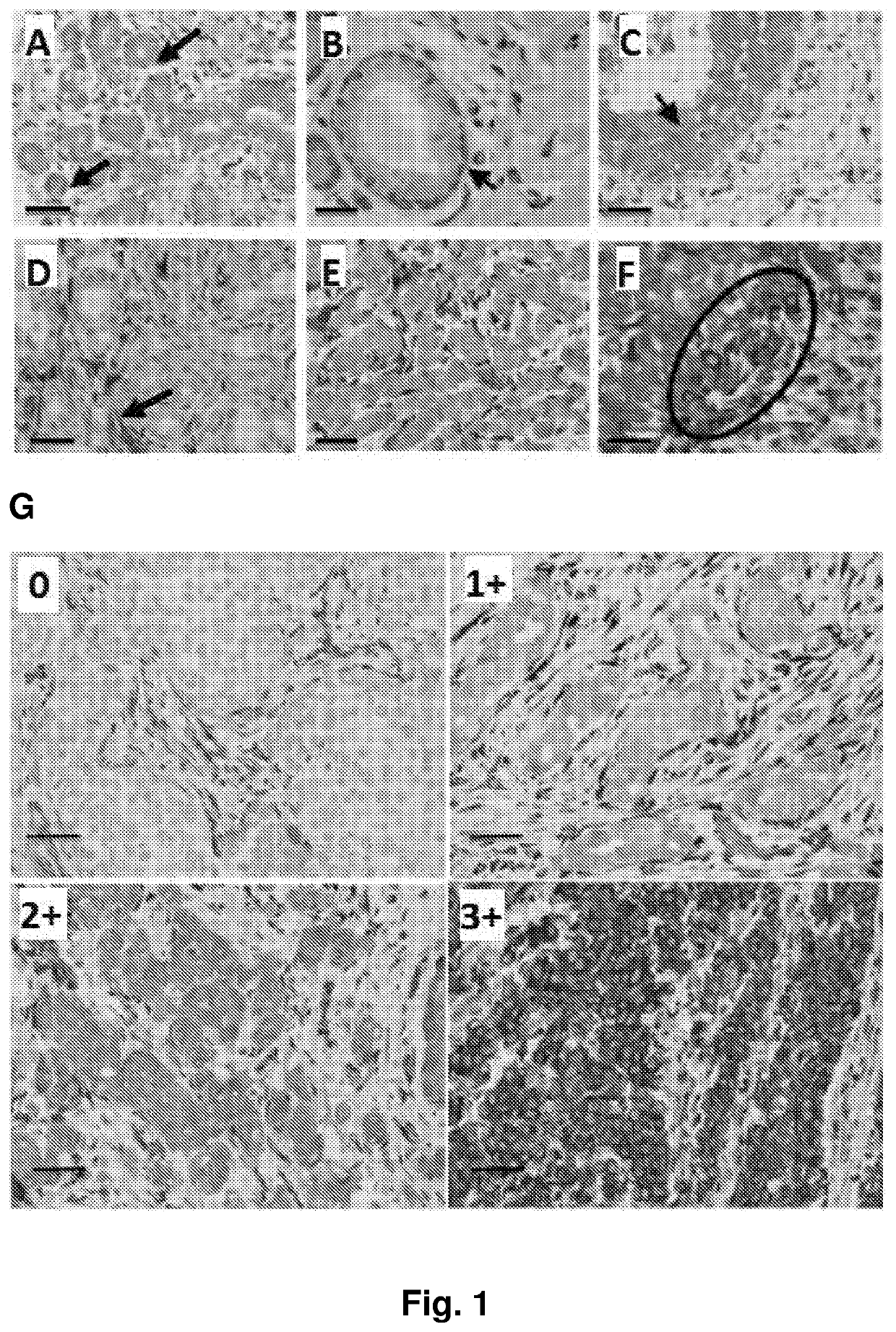 Treatment of er-negative breast cancer with an pdgf-cc inhibitor and Anti-estrogen