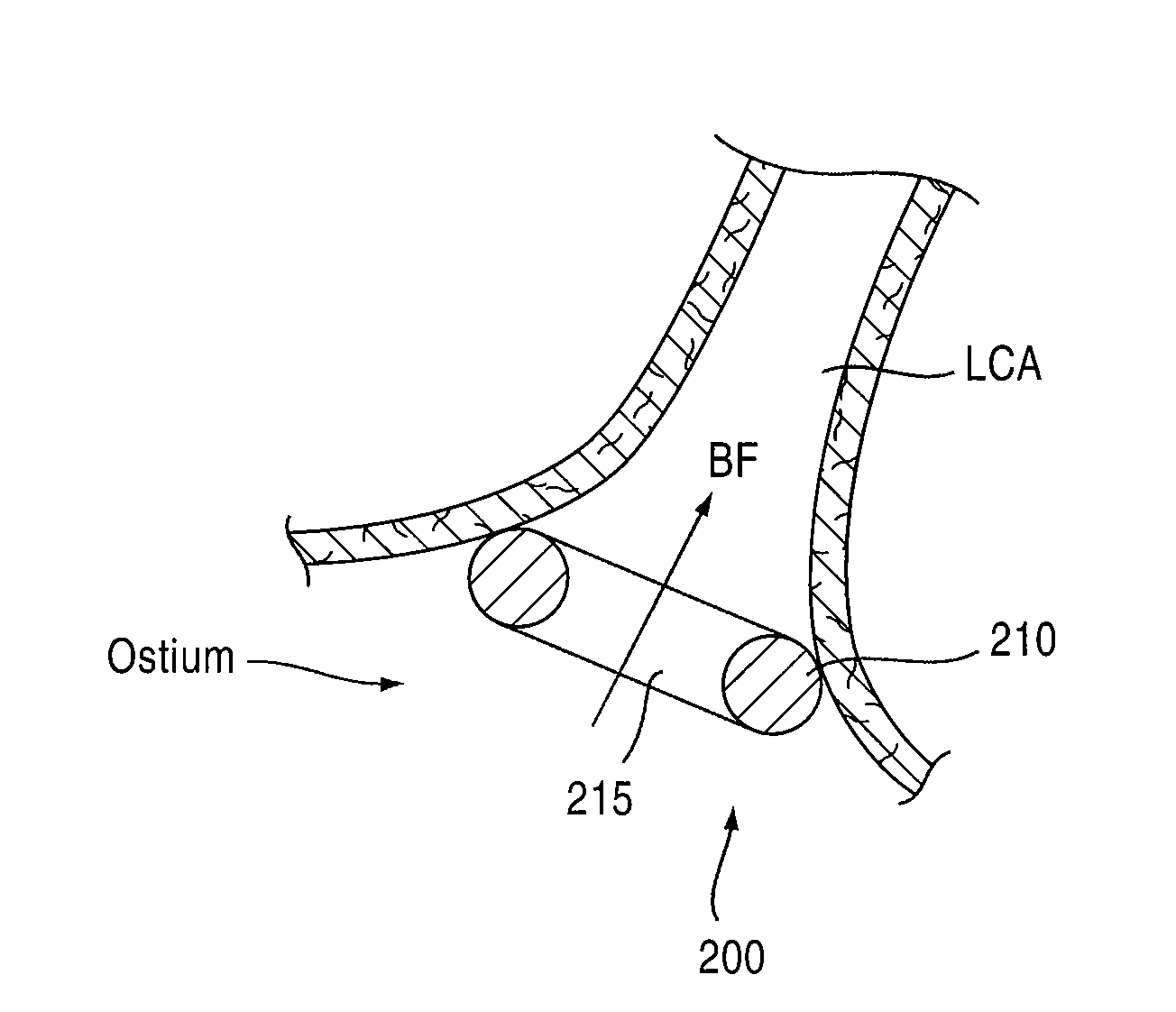 Apparatuses and methods to treat atherosclerotic plaques