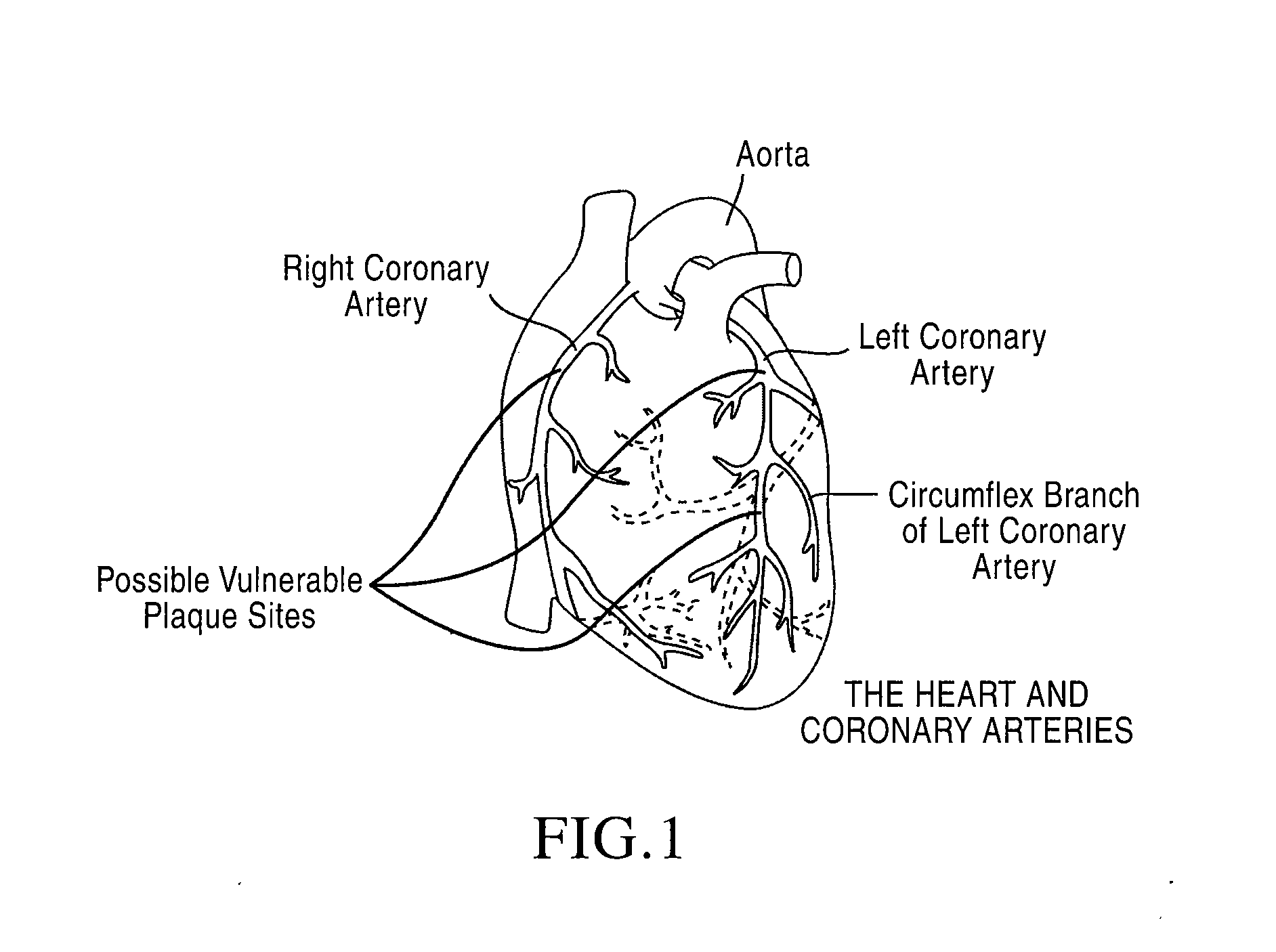 Apparatuses and methods to treat atherosclerotic plaques