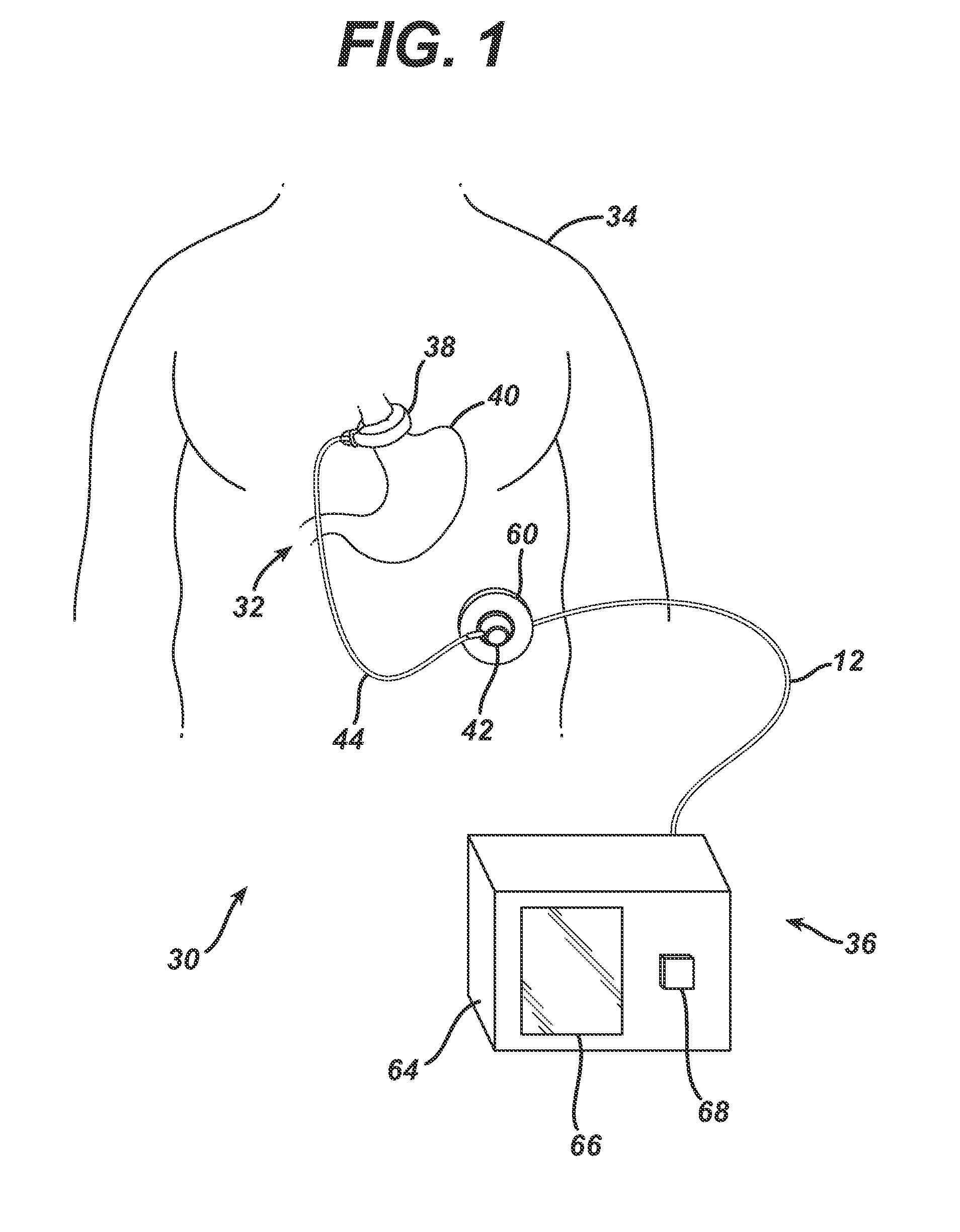 Non-Invasive Measurement Of Fluid Pressure In An Adjustable Gastric Band