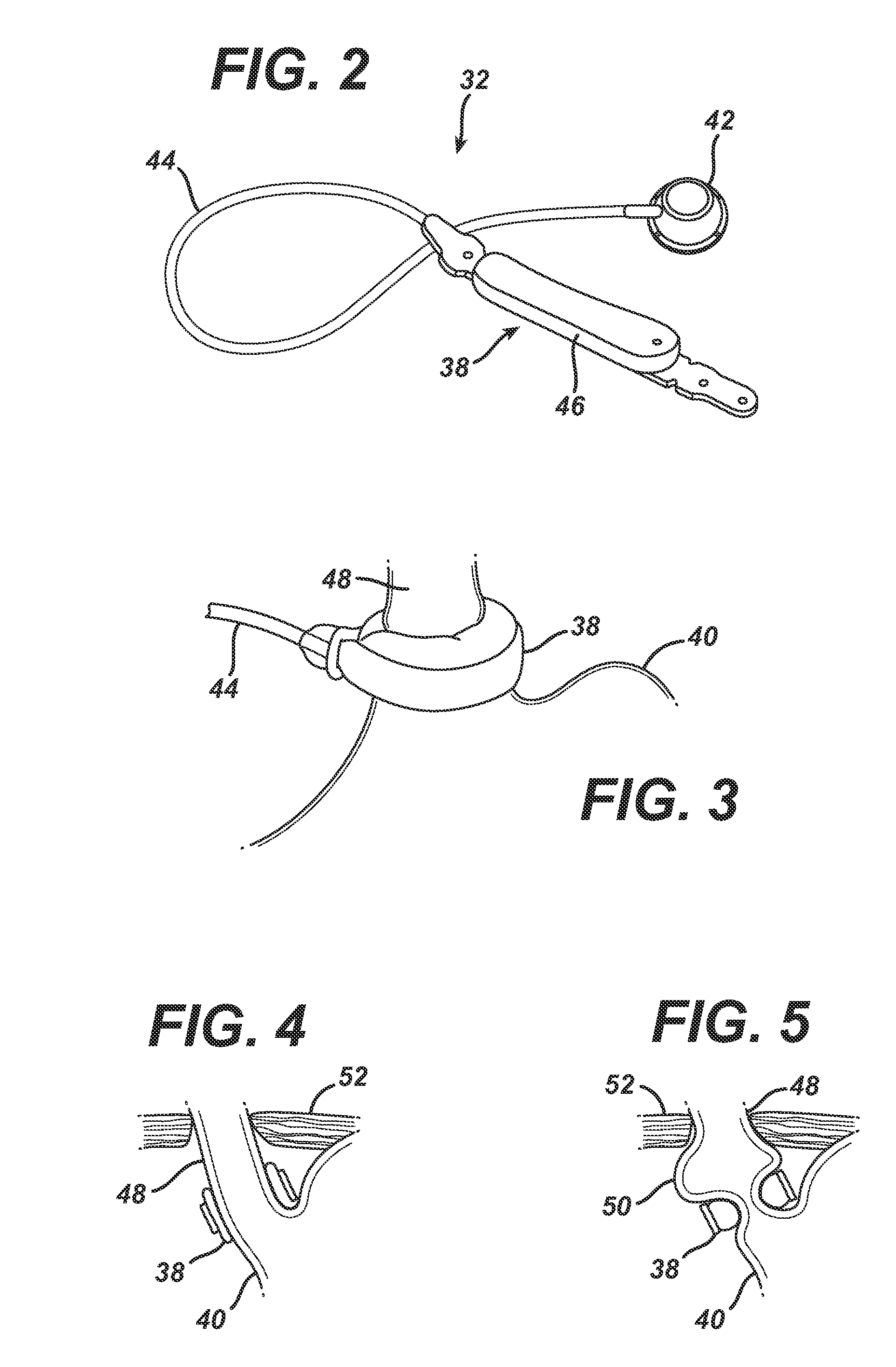 Non-Invasive Measurement Of Fluid Pressure In An Adjustable Gastric Band