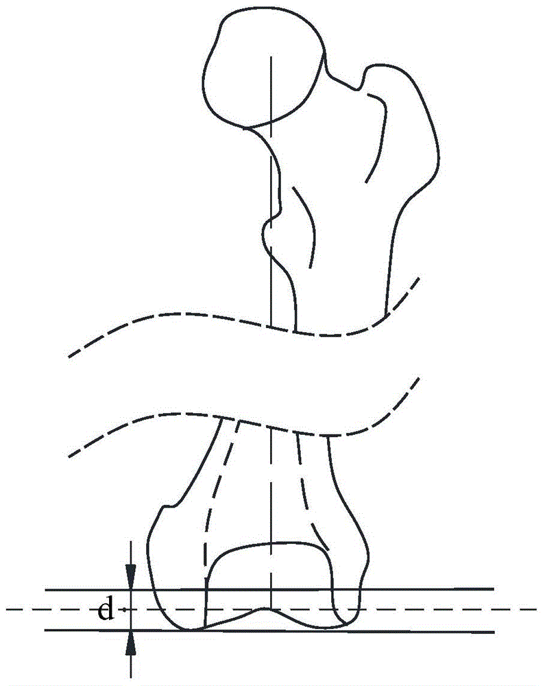 Total knee replacement digital osteotomy guiding plate manufacturing method and device