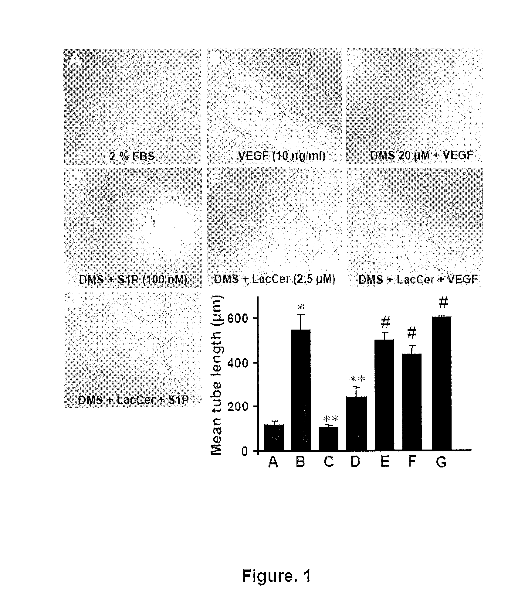 Use of the Lactosylceramide Synthase Isoform B1,4GALT-V as a Biomarker for Cancer