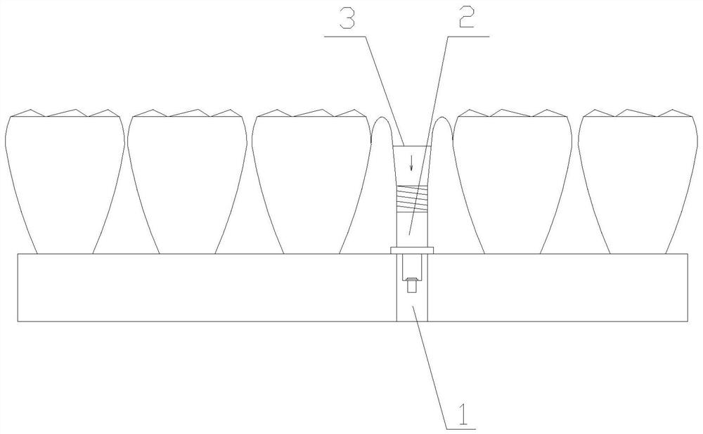 Diastema closing device