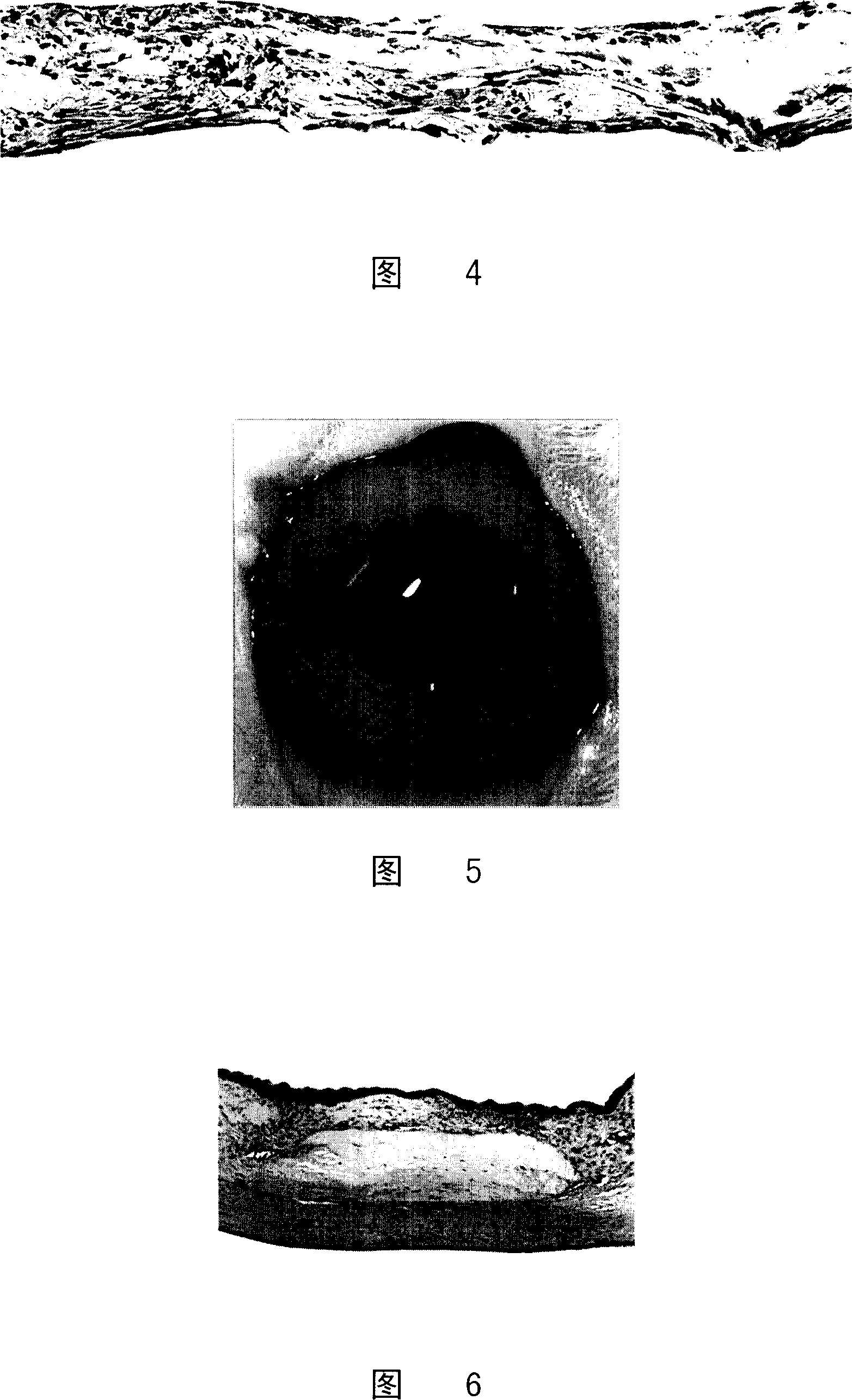 Corneal graft