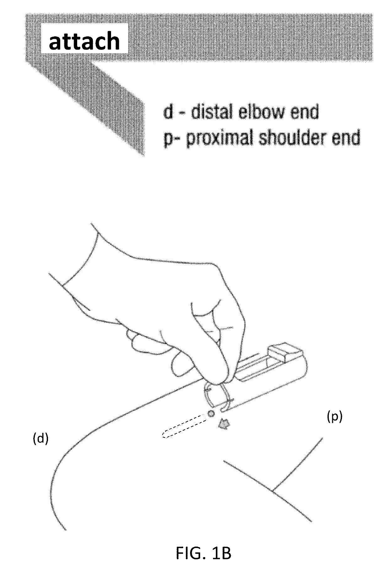 Device for Removing an Item Implanted Underneath the Skin