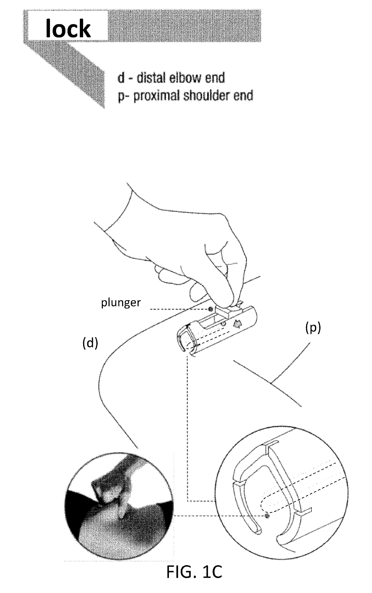 Device for Removing an Item Implanted Underneath the Skin