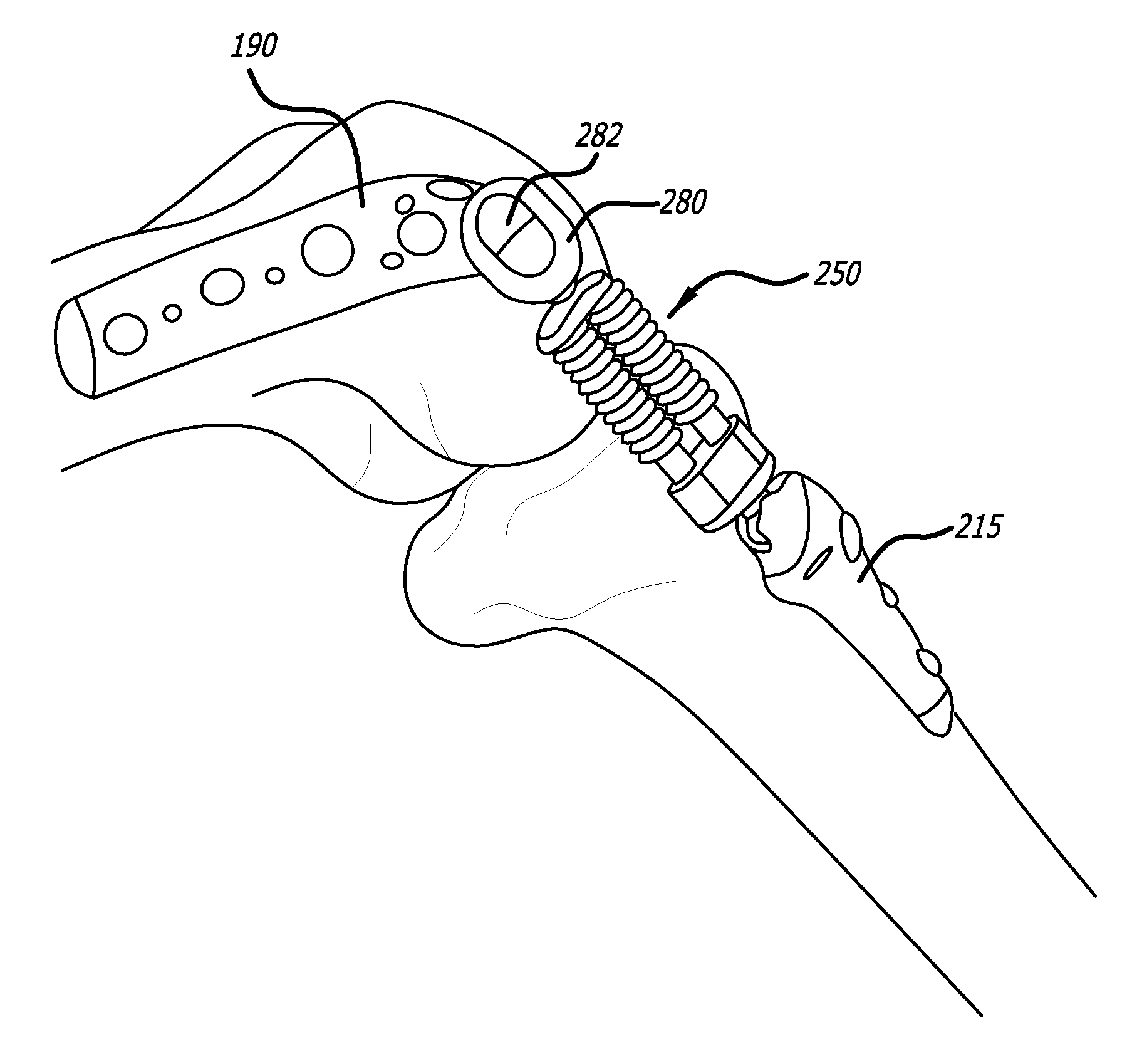 Surgical implantation method and devices for an extra-articular mechanical energy absorbing apparatus