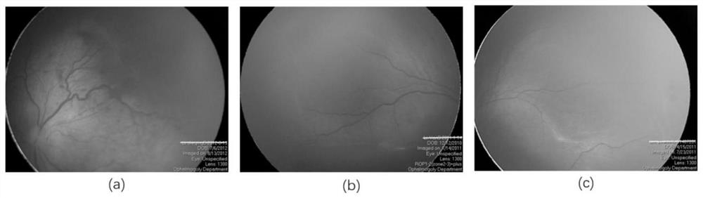 Premature infant retinopathy automatic partition recognition method based on attention mechanism and deep supervision strategy