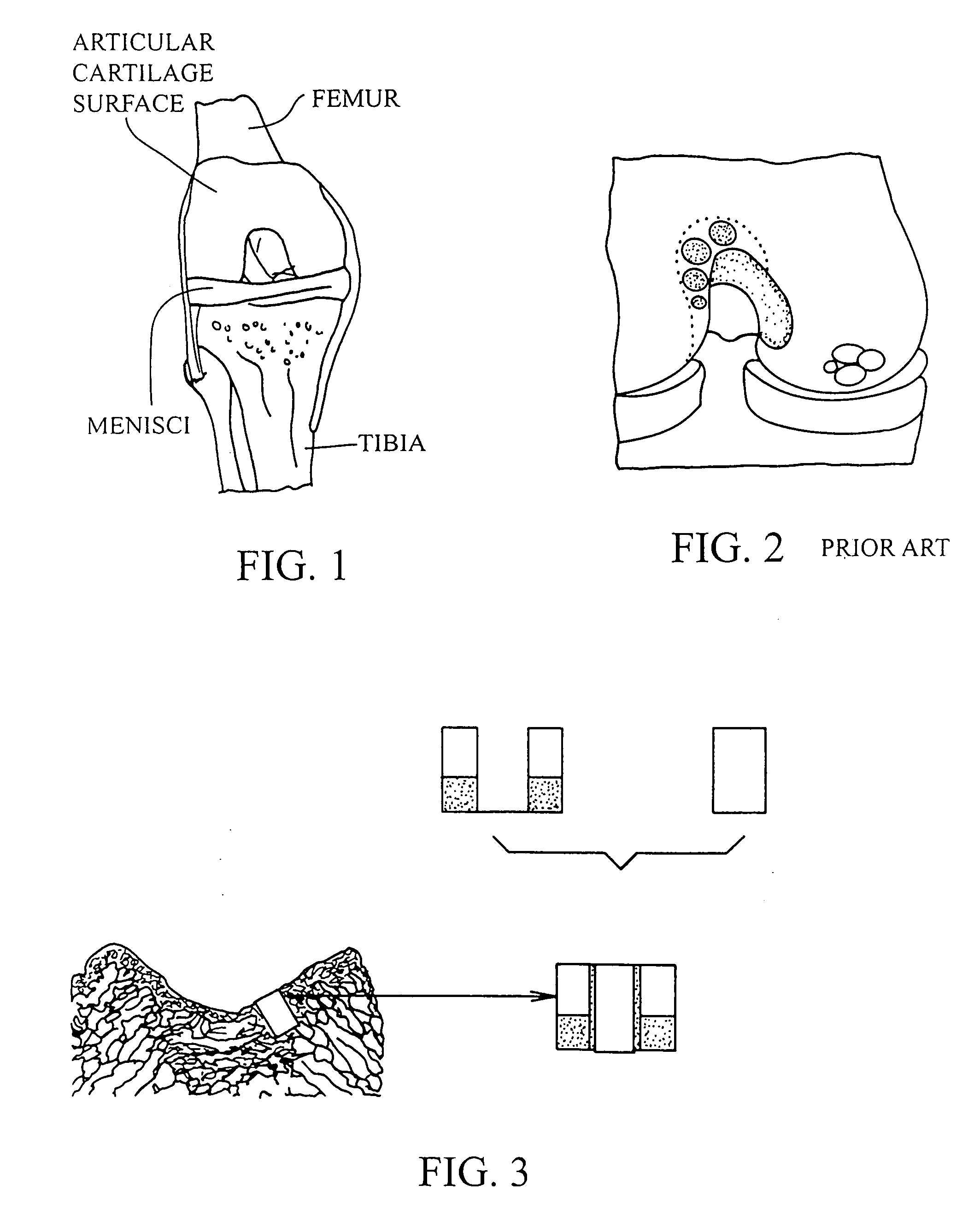 Cartilage implant plug with fibrin glue and method for implantation