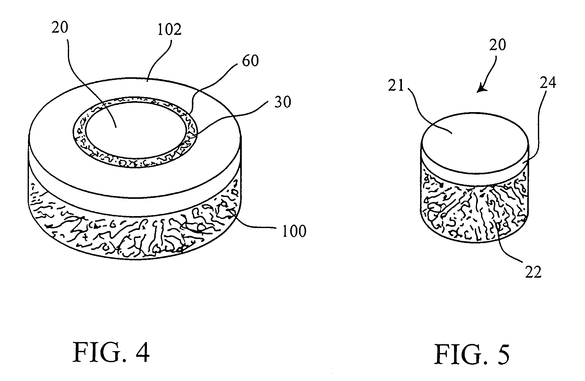 Cartilage implant plug with fibrin glue and method for implantation