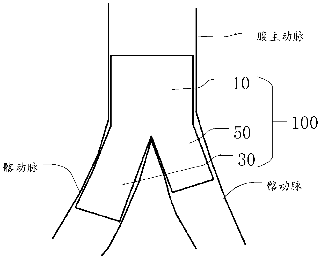 Bifurcation bracket