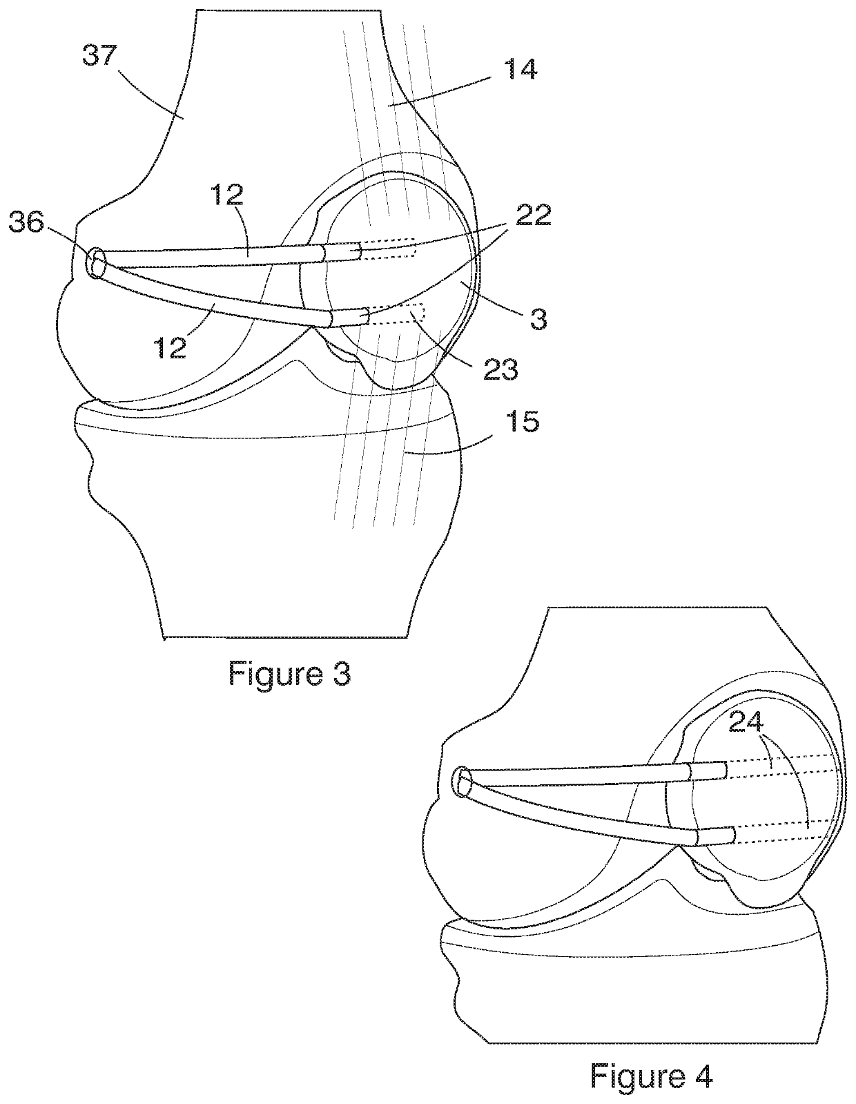 Accessory for conducting patella surgery