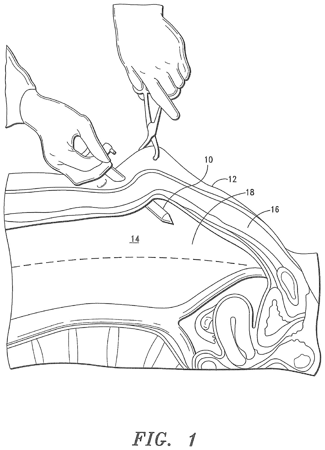 Biological tissue access and closure apparatus, systems and methods