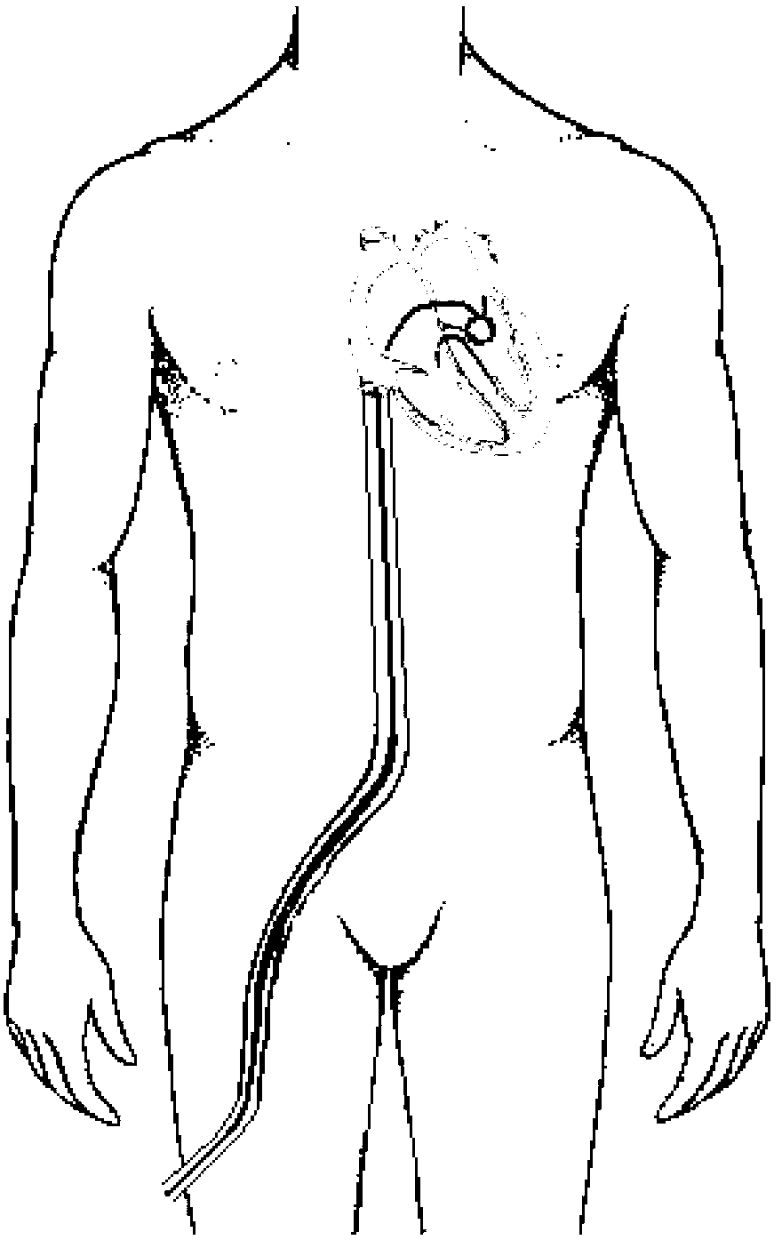 Adjustable bicuspid valve forming device