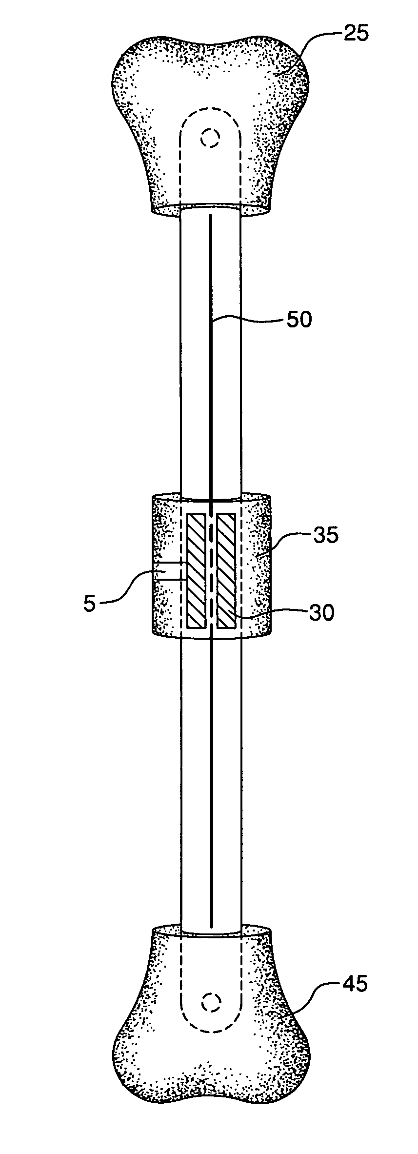 Internal bone transport